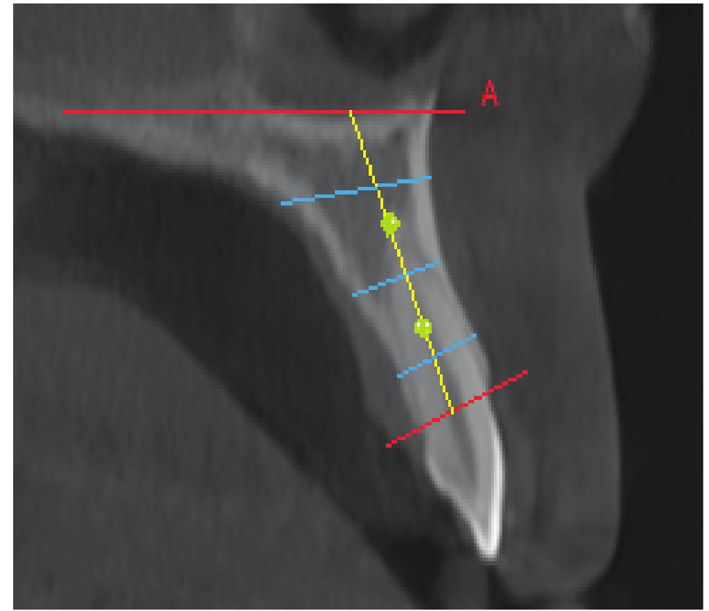 (PDF) Assessment of Alveolar Bone Height and Width in Maxillary ...