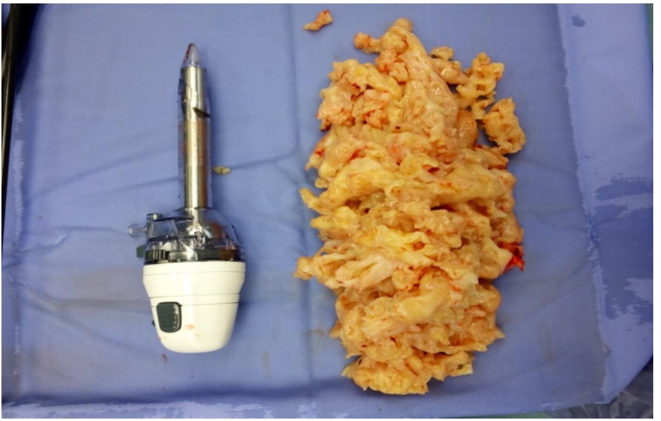 (PDF) Fibroid Removal after Myomectomy: An Overview on the Problems of ...