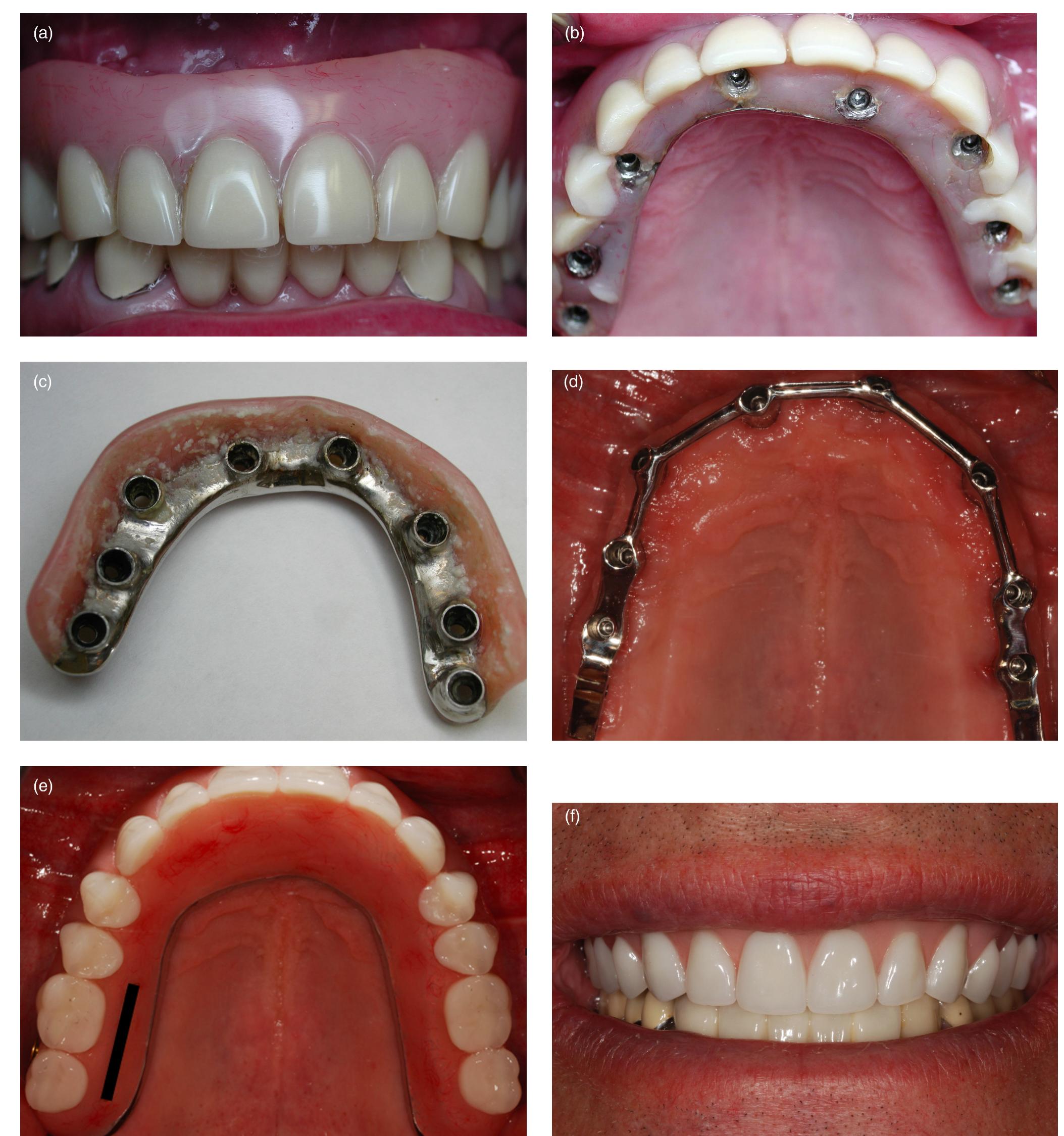 Maxillary Prosthesis 13 (a) maxillary and mandibular immediate load prostheses.