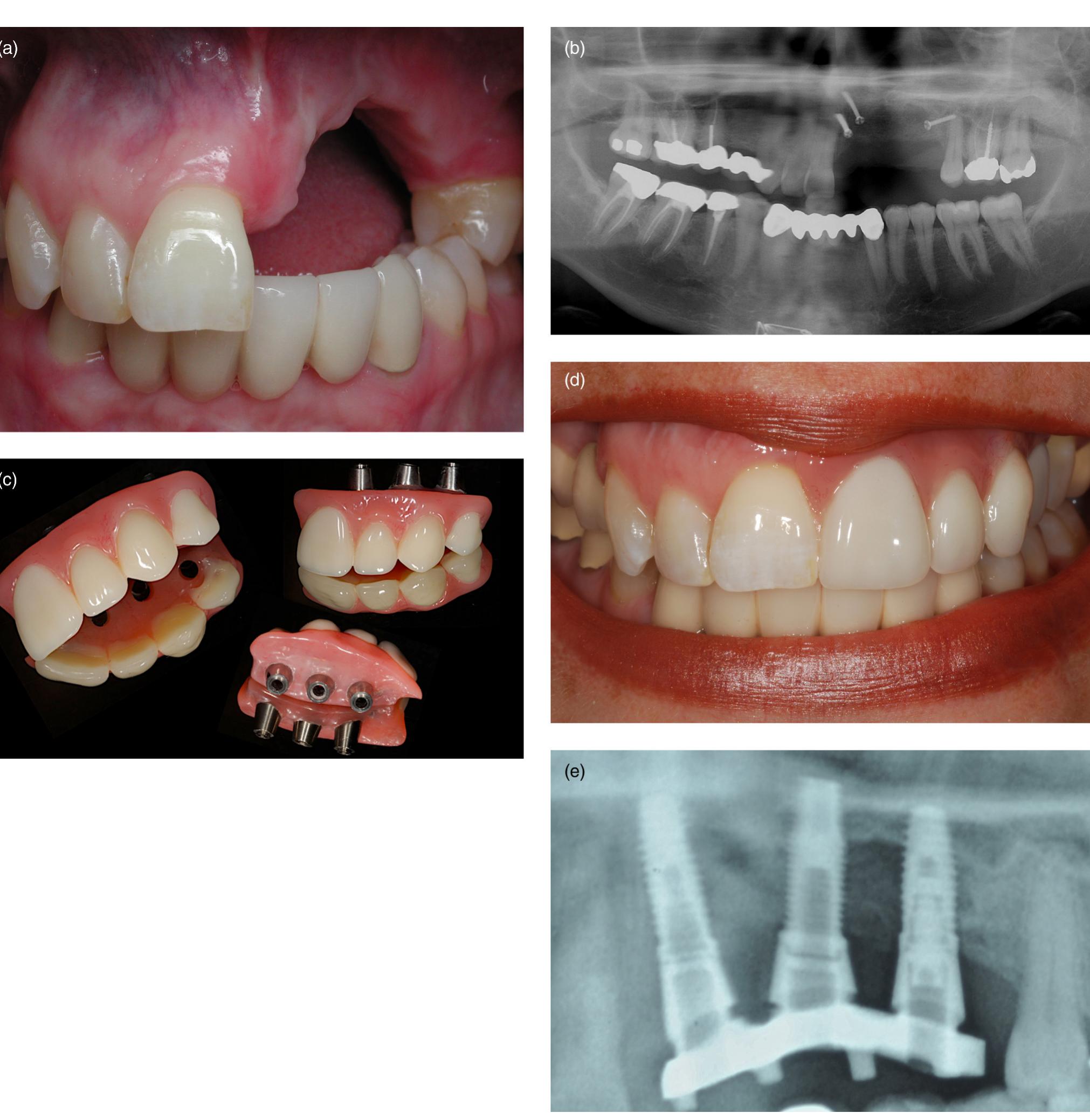 (PDF) Vertical Alveolar Ridge Augmentation in Implant Dentistry