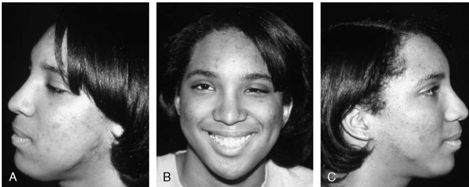 Normal Cheek Projection (a,b,c) achievement of facial symmetry and projection is