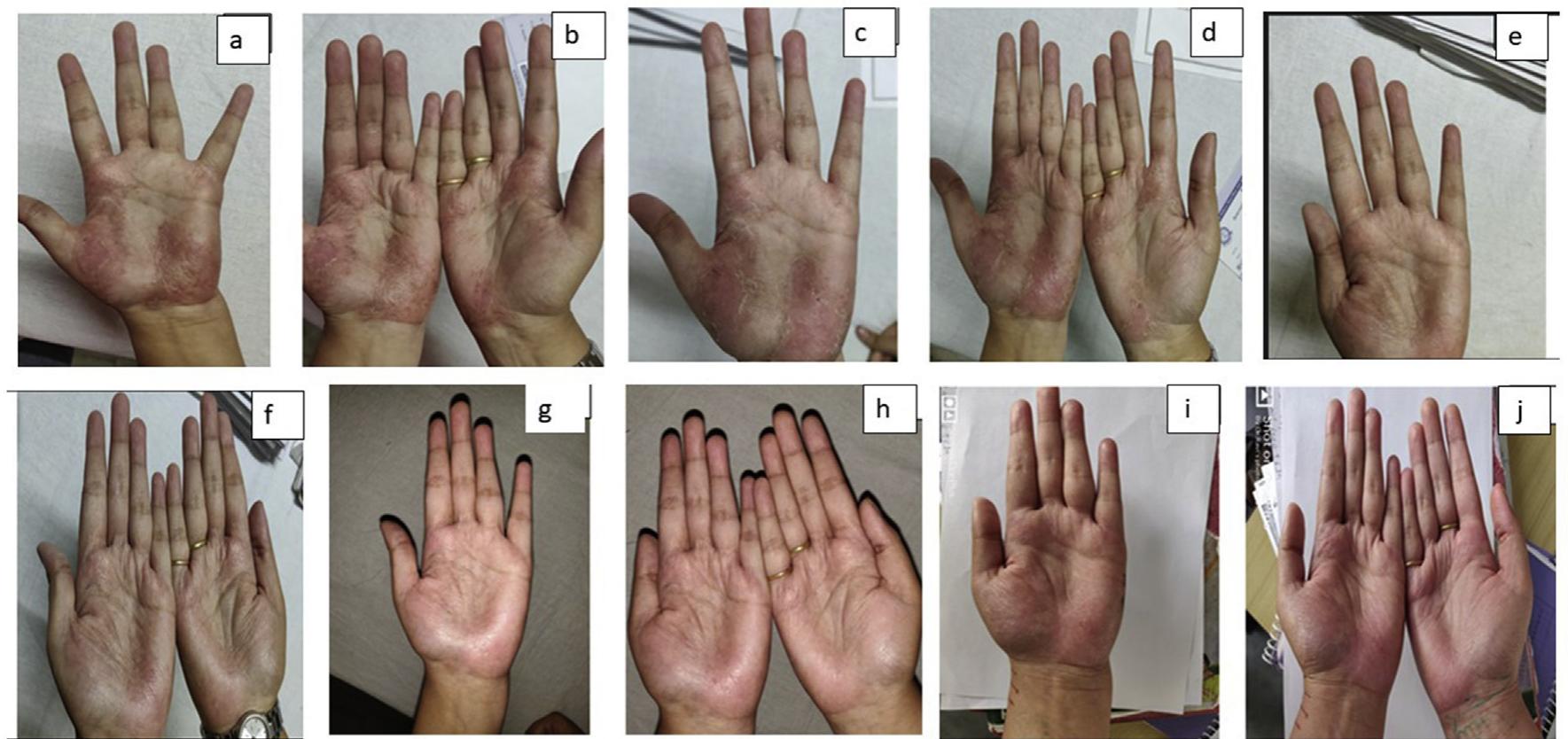 Tapioca Like Rash (PDF) Ayurvedic visha hara (antitoxic) chikitsa in recurrent ...