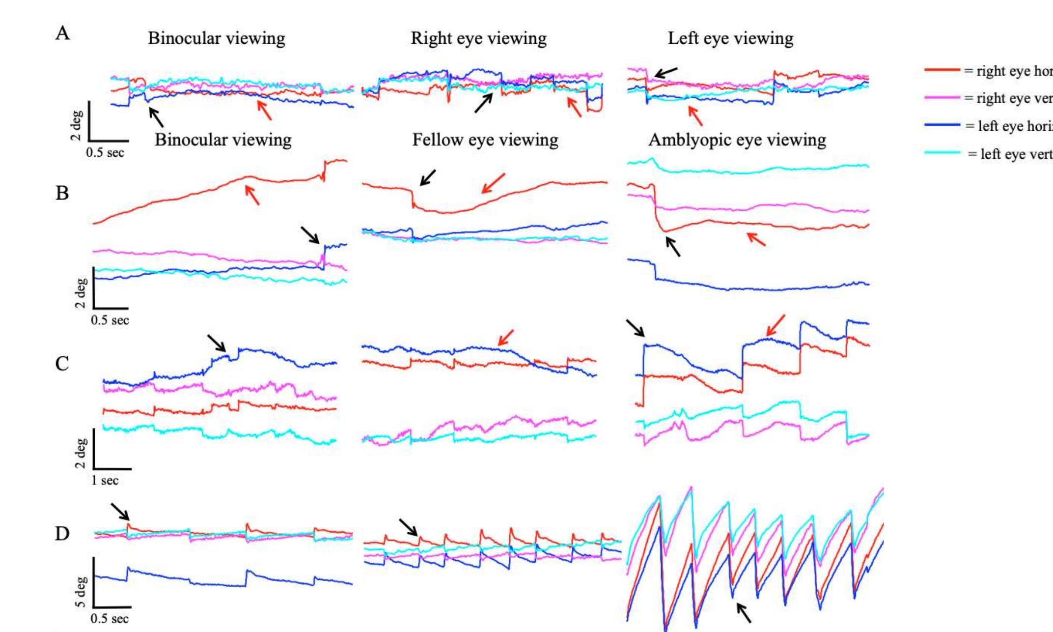 (PDF) Fixational eye movement waveforms in amblyopia: Characteristics ...