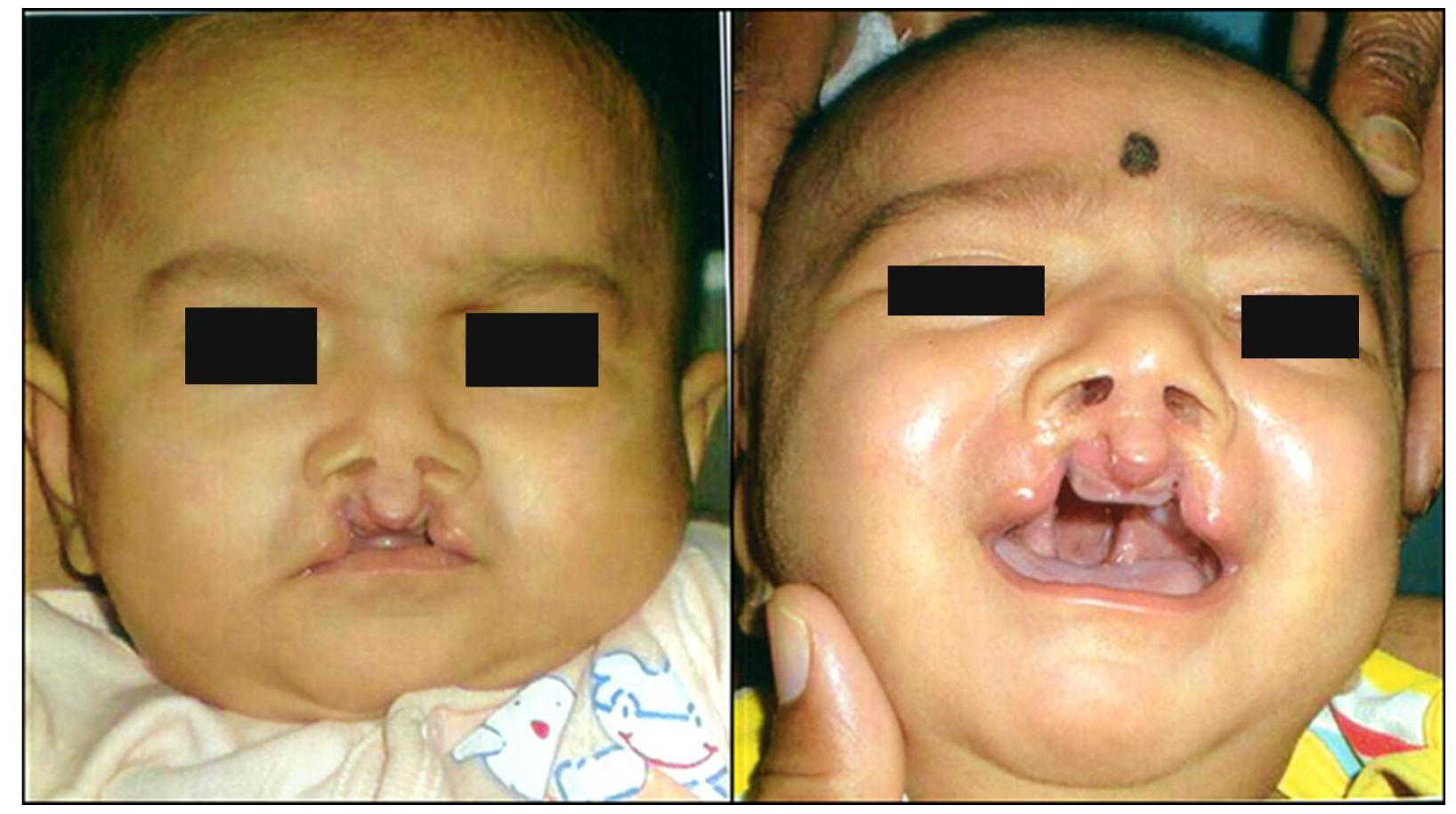 (PDF) Presurgical nasoalveolar moulding: A boon in the management of ...