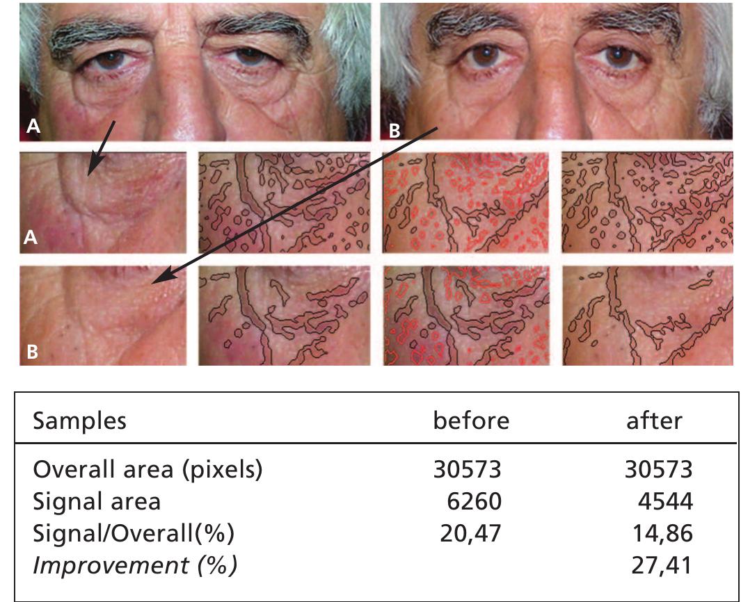 (PDF) Nonablative Wrinkle Treatment of the Face and Neck Using a ...