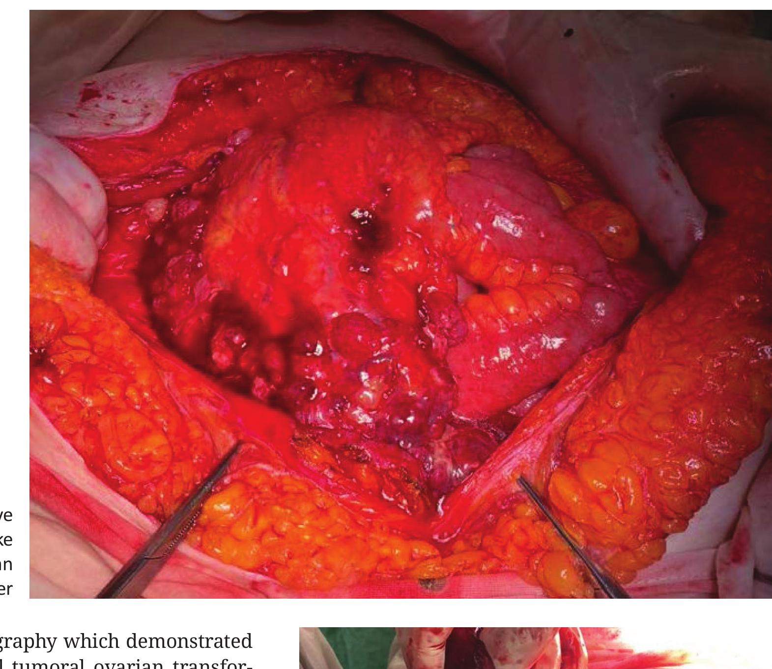 (PDF) Omental cake invading the urinary bladder – a case report and ...