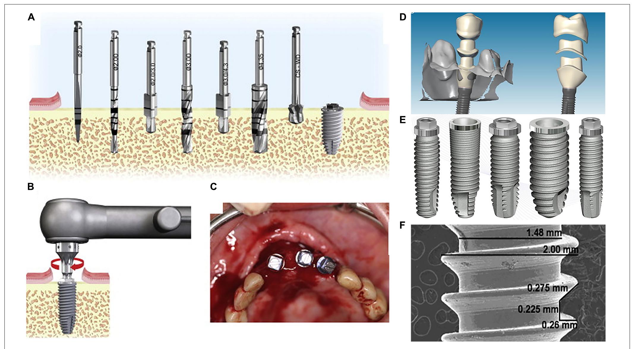 | schematic representation of the nano-engineered titanium