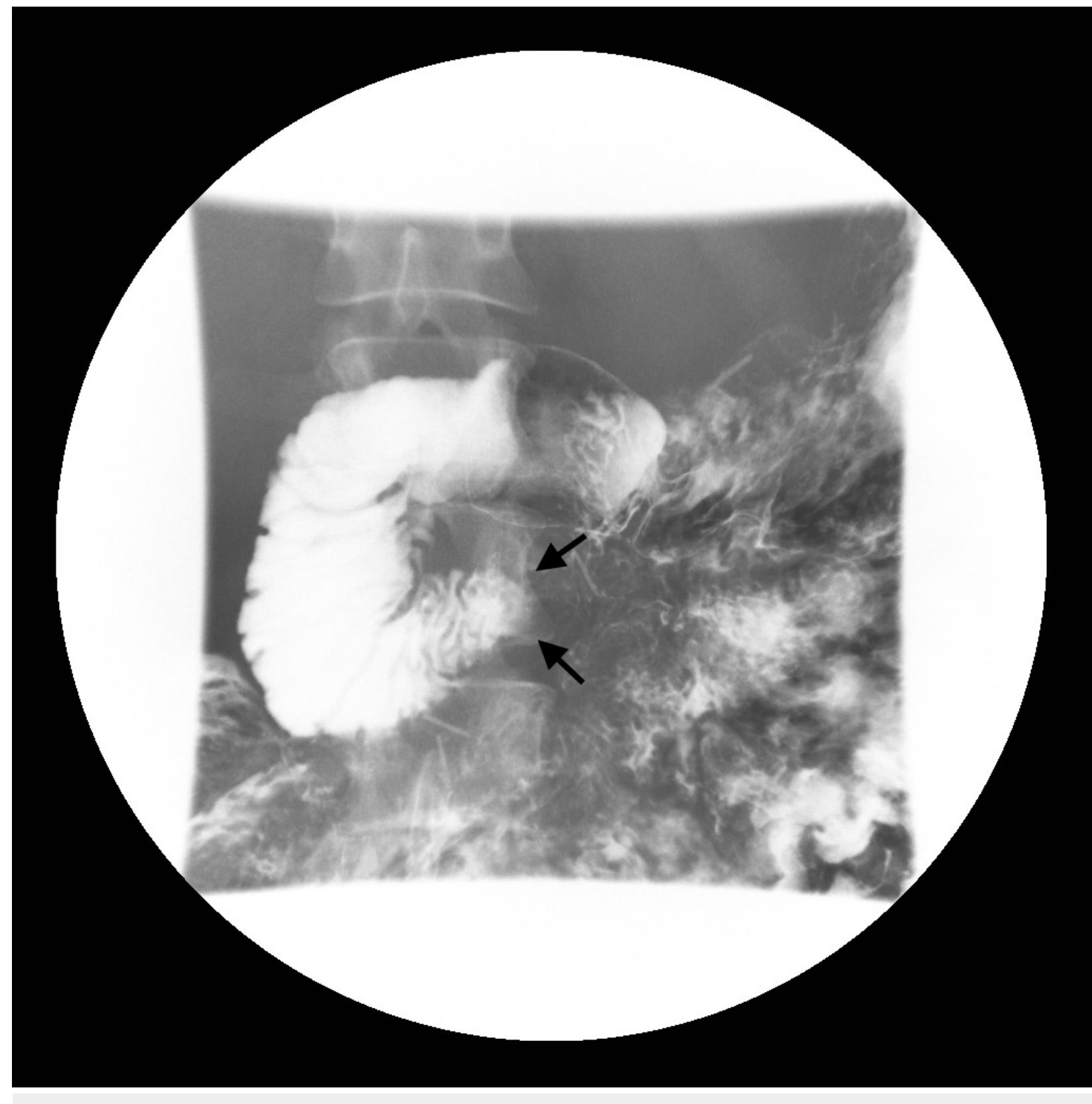 Contrast Pooling (PDF) Clinical and Radiologic Considerations for Idiopathic Superior ...