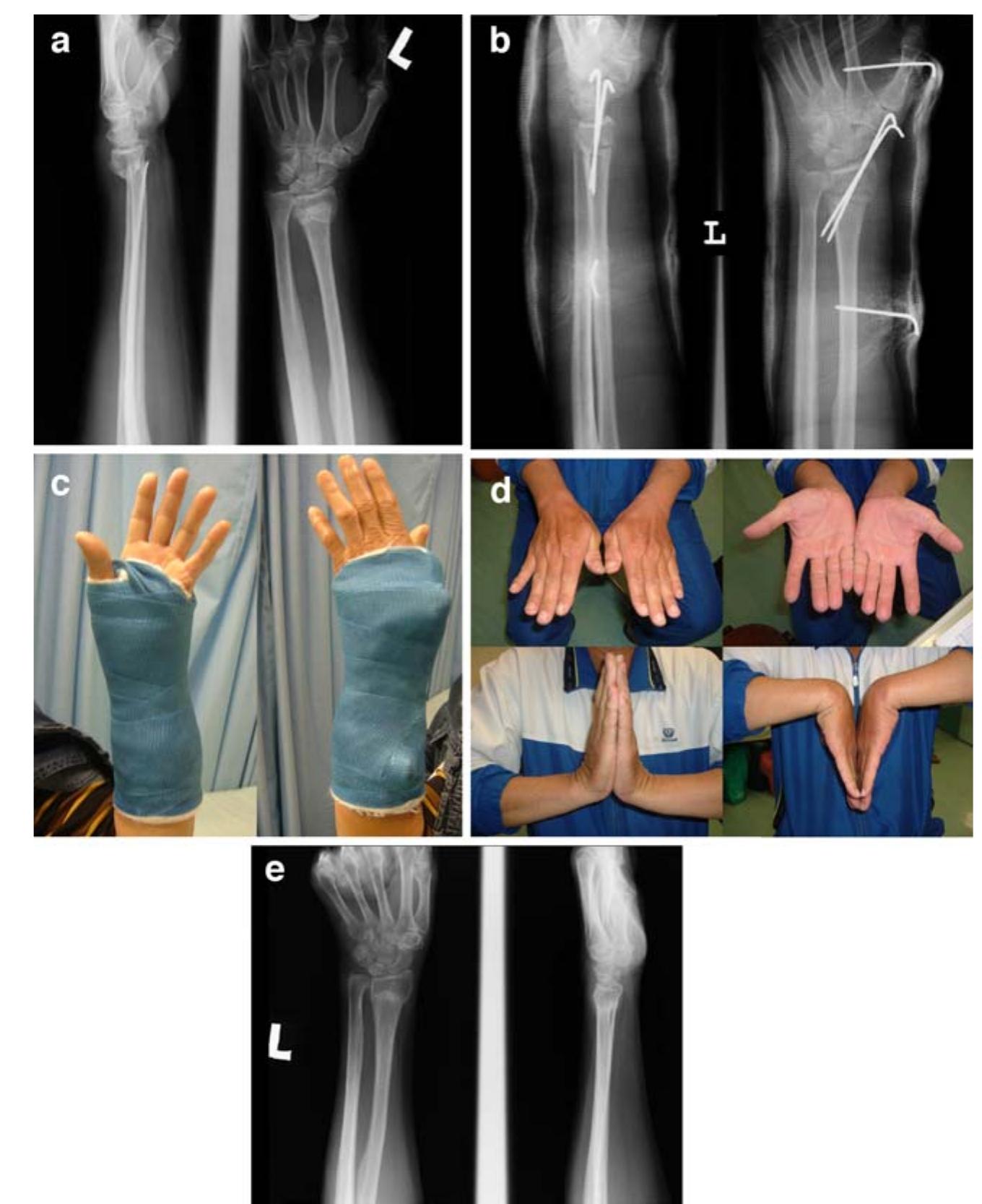 (PDF) Treatment of Distal Radius Fractures with Percutaneous Pinning ...
