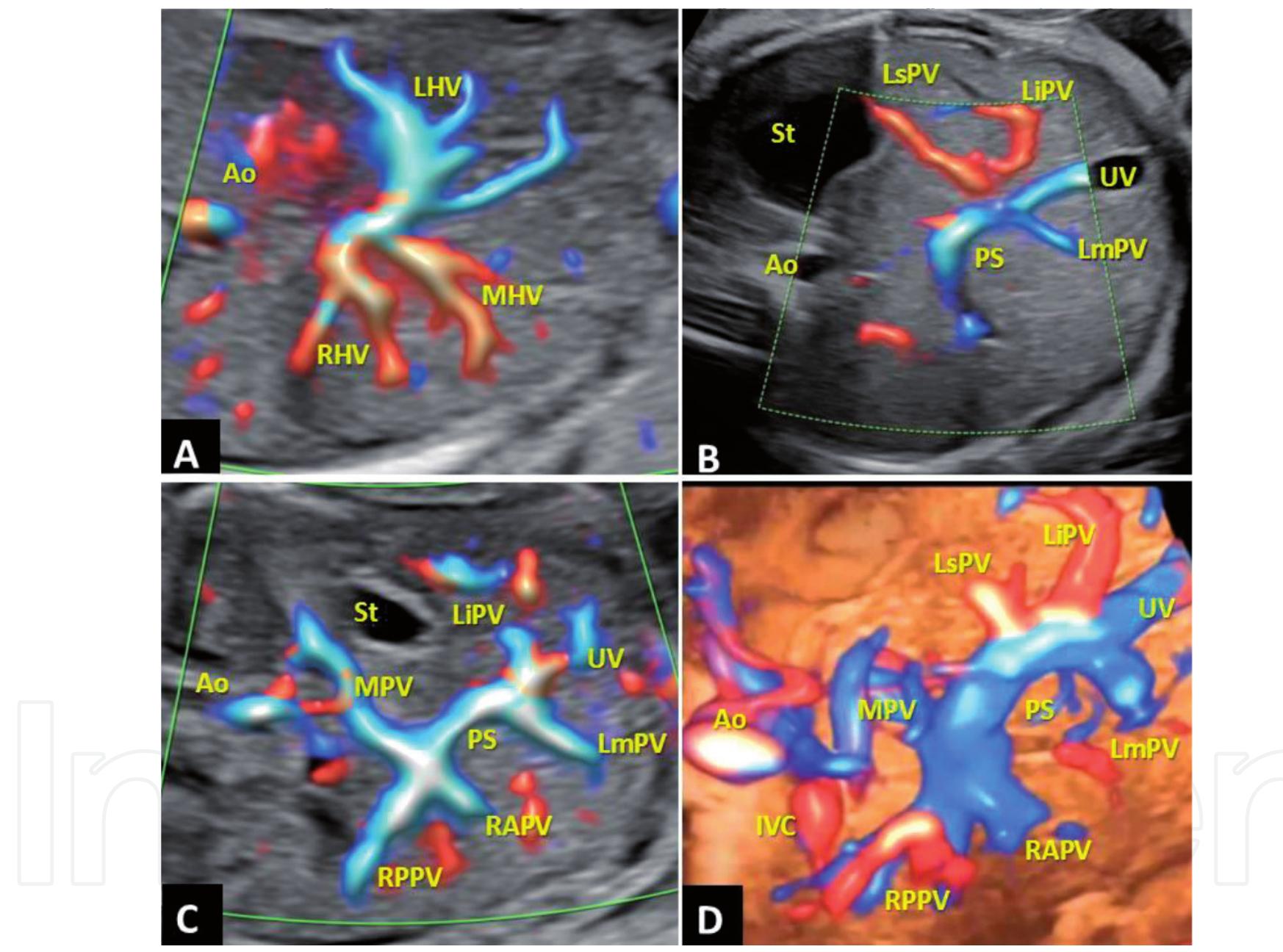 Rapv Rppv (PDF) The Hepatic Fetal Venous System