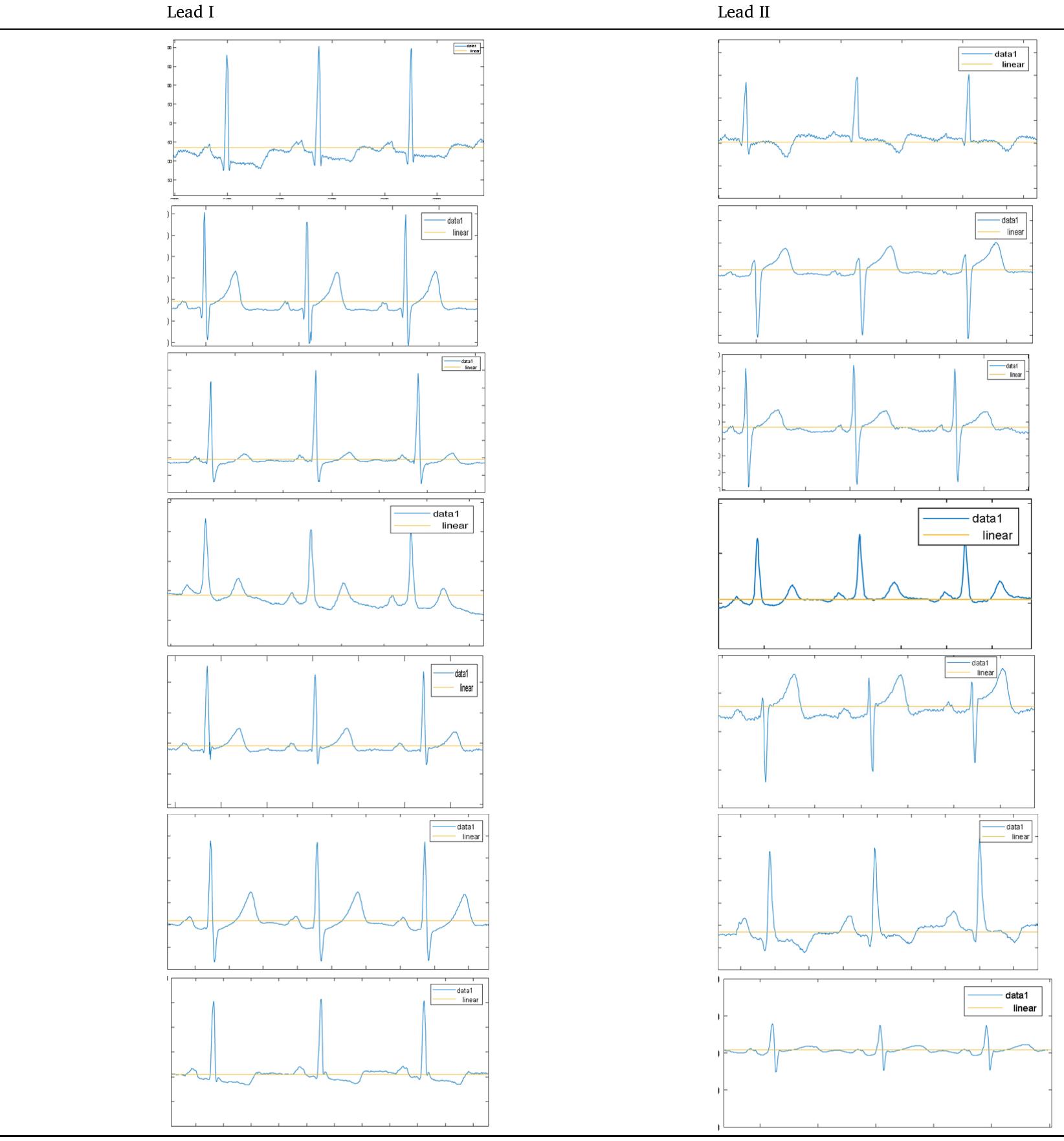(PDF) Semantic segmentation of ECG waves using hybrid channel-mix ...