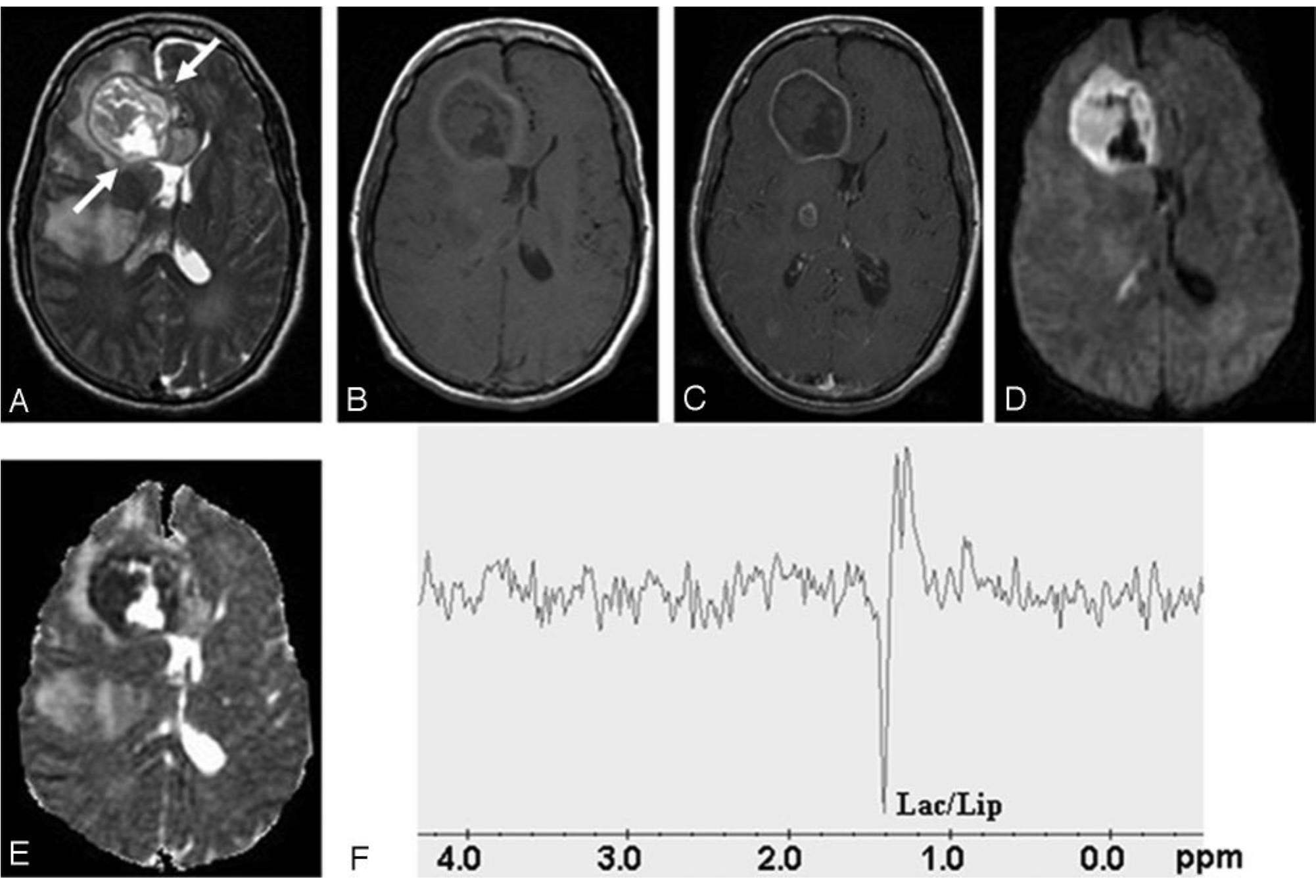 (PDF) Comparative Evaluation of Fungal, Tubercular, and Pyogenic Brain ...