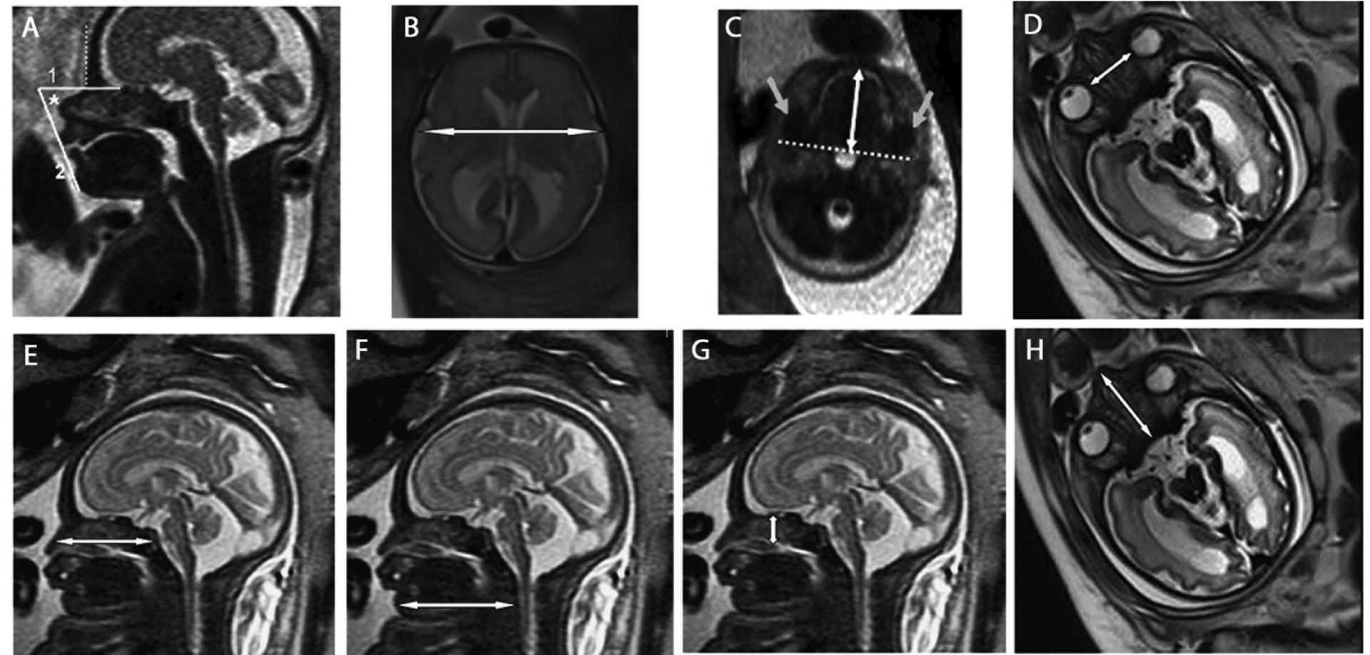 Interocular Distance Radiology (PDF) What does the normal fetal face look like? MR imaging of the ...