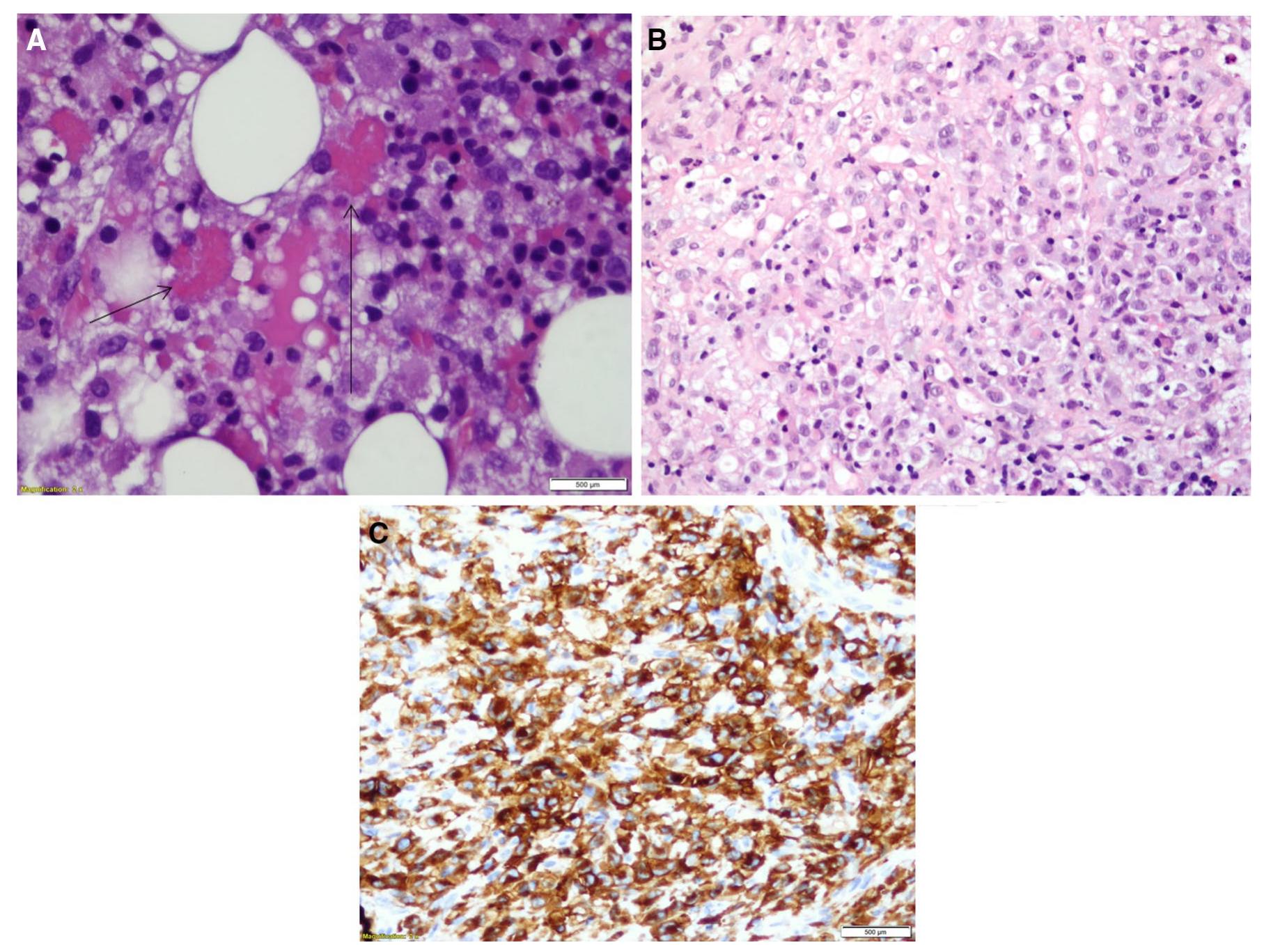 (PDF) Hemophagocytic lymphohistiocytosis as a harbinger of aggressive ...