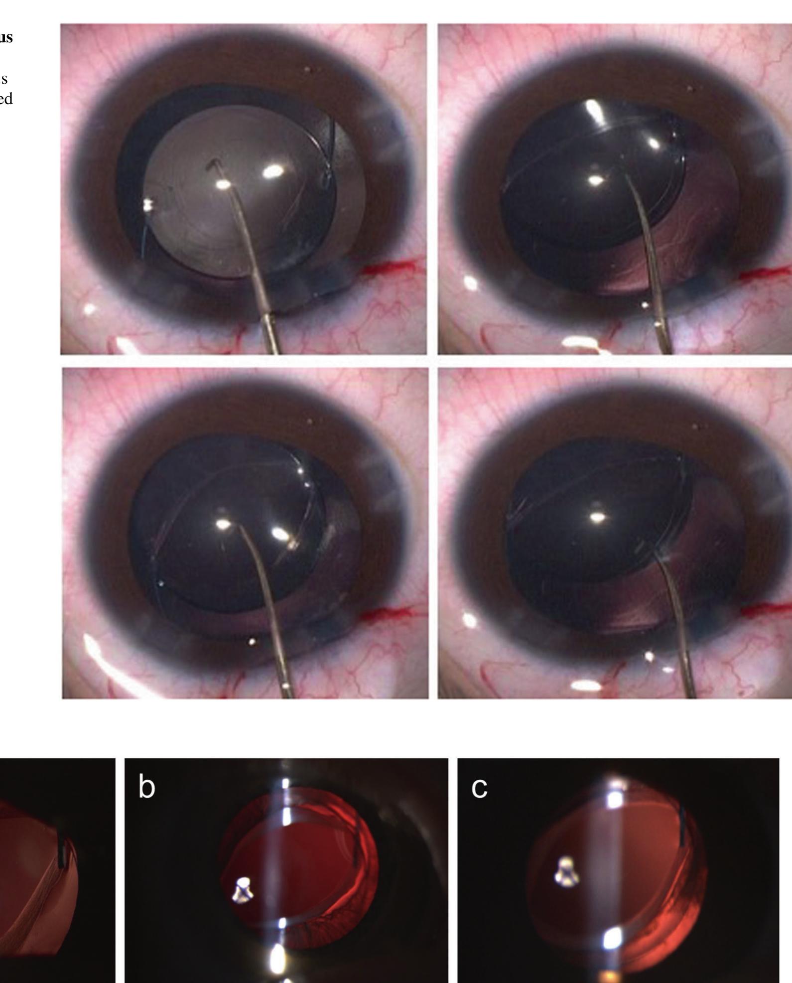 Seldom Visual (PDF) Cataract management in children: a review of the literature and ...