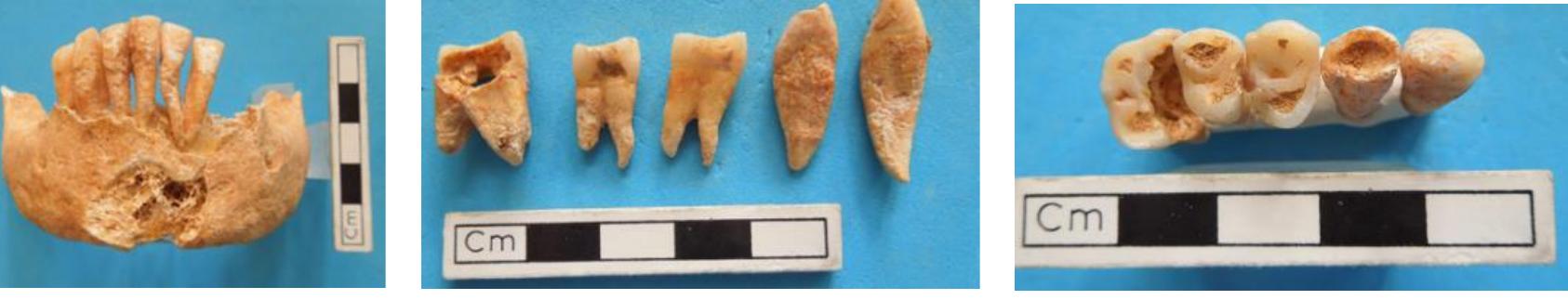 I? with cavities and wear 