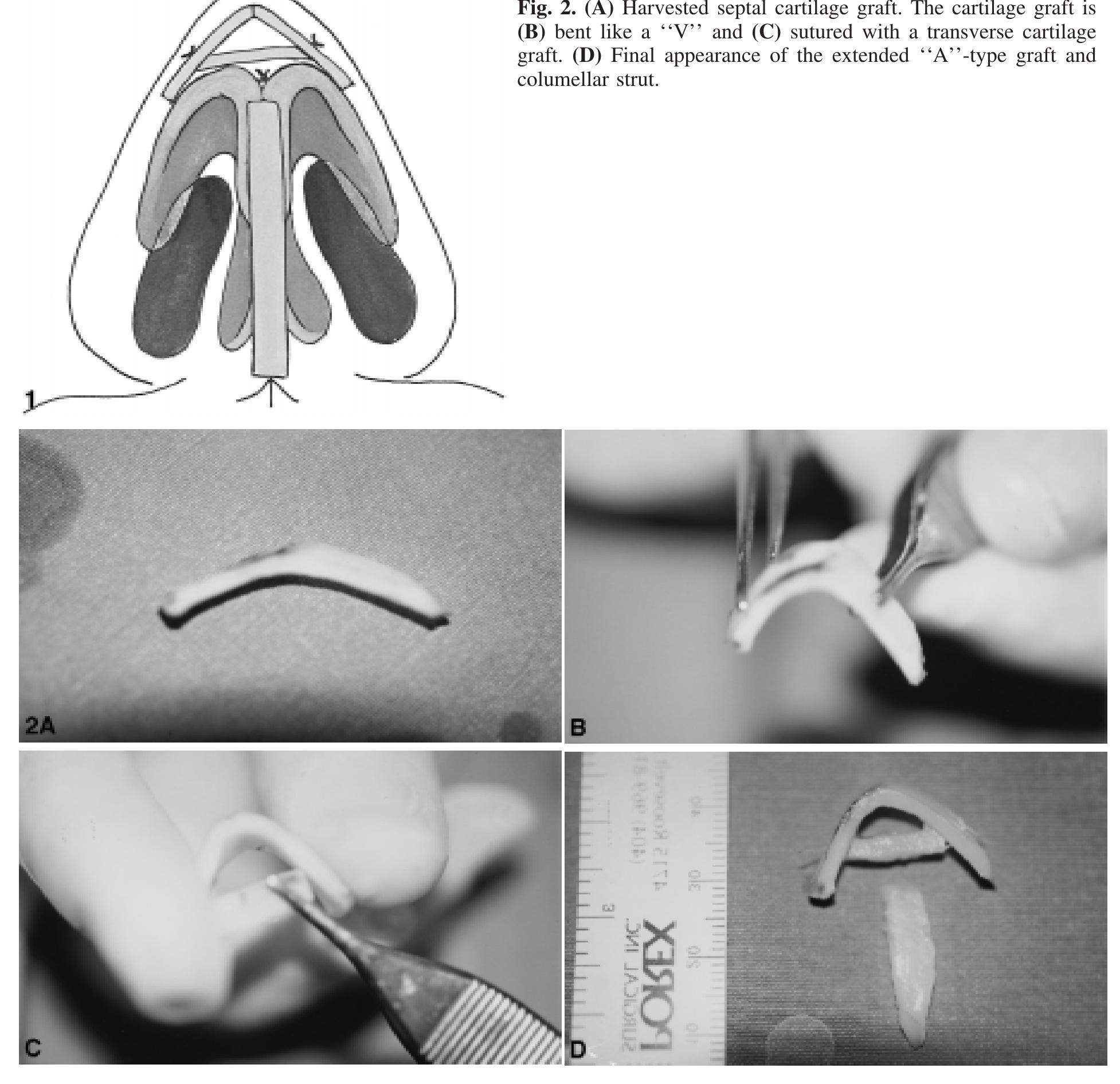 Osr Inverted V Incision (PDF) A New Extrasupported Tip Graft in the Treatment of Bulbous Nasal Tip