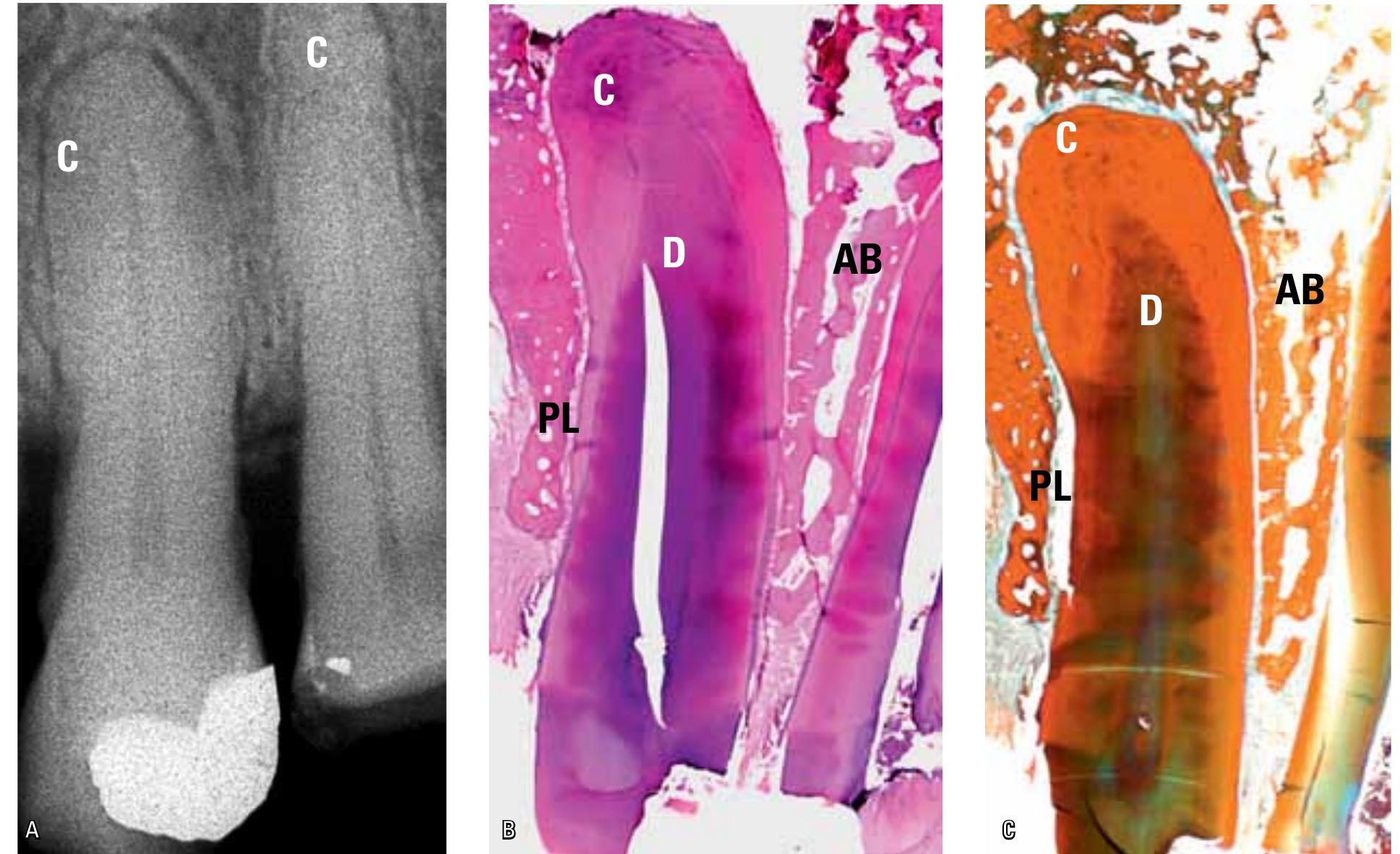 Hypercementosis Radiographic Figure 1 - from Cementum, apical morphology and