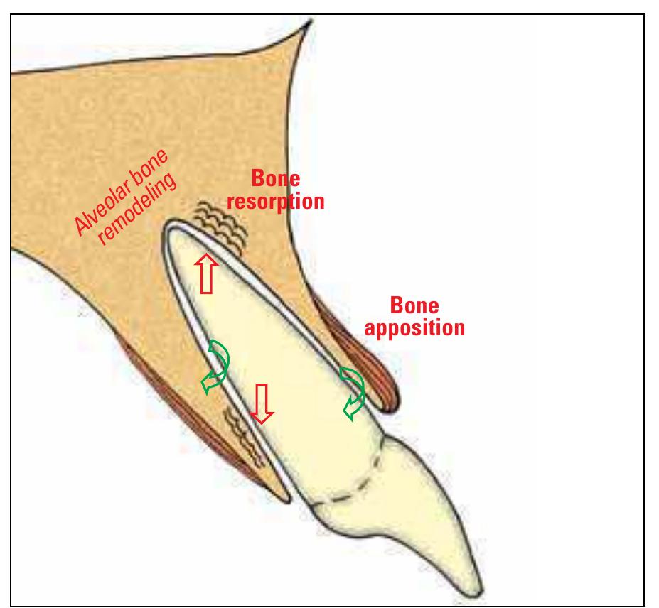 Stimulus Tooth (PDF) Intrusive mechanics generates inclination forces and orthopedic ...