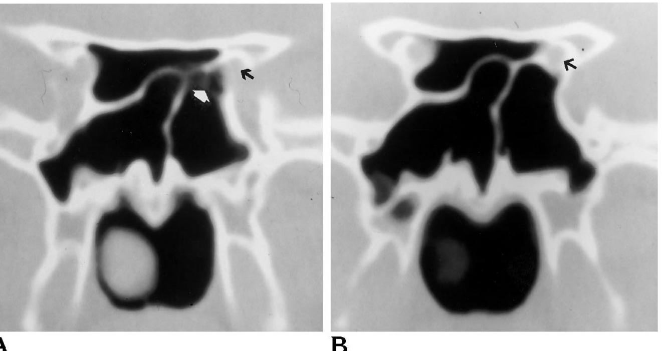 (PDF) Relationship of the optic nerve to the posterior paranasal ...