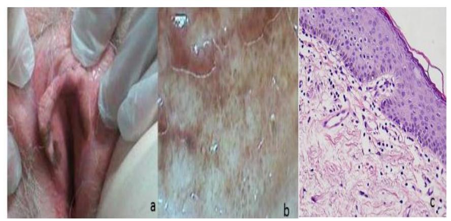 PDF) Vulvar Melanosis: Two Case Report