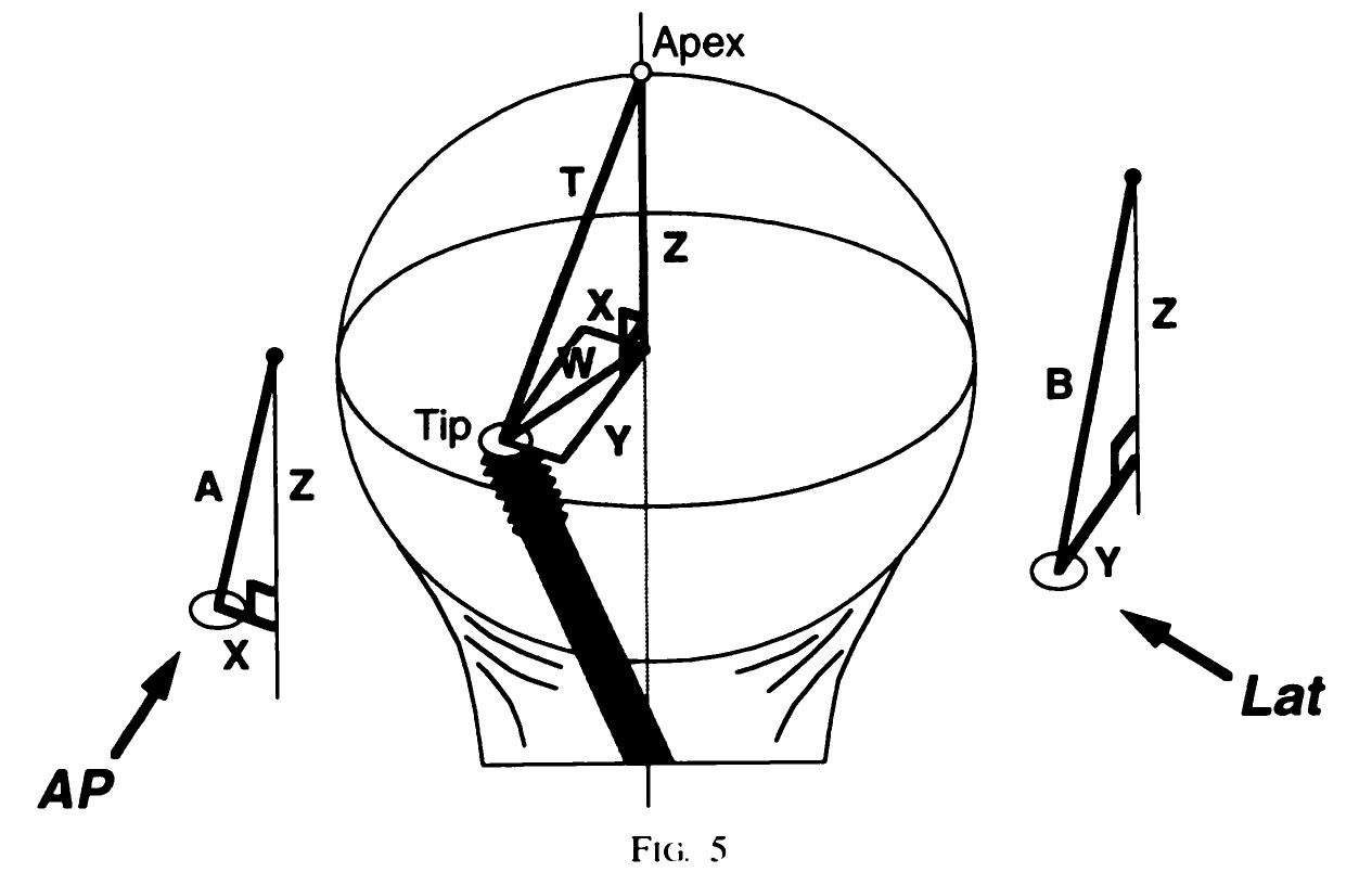 (PDF) The value of the tip-apex distance in predicting failure of ...