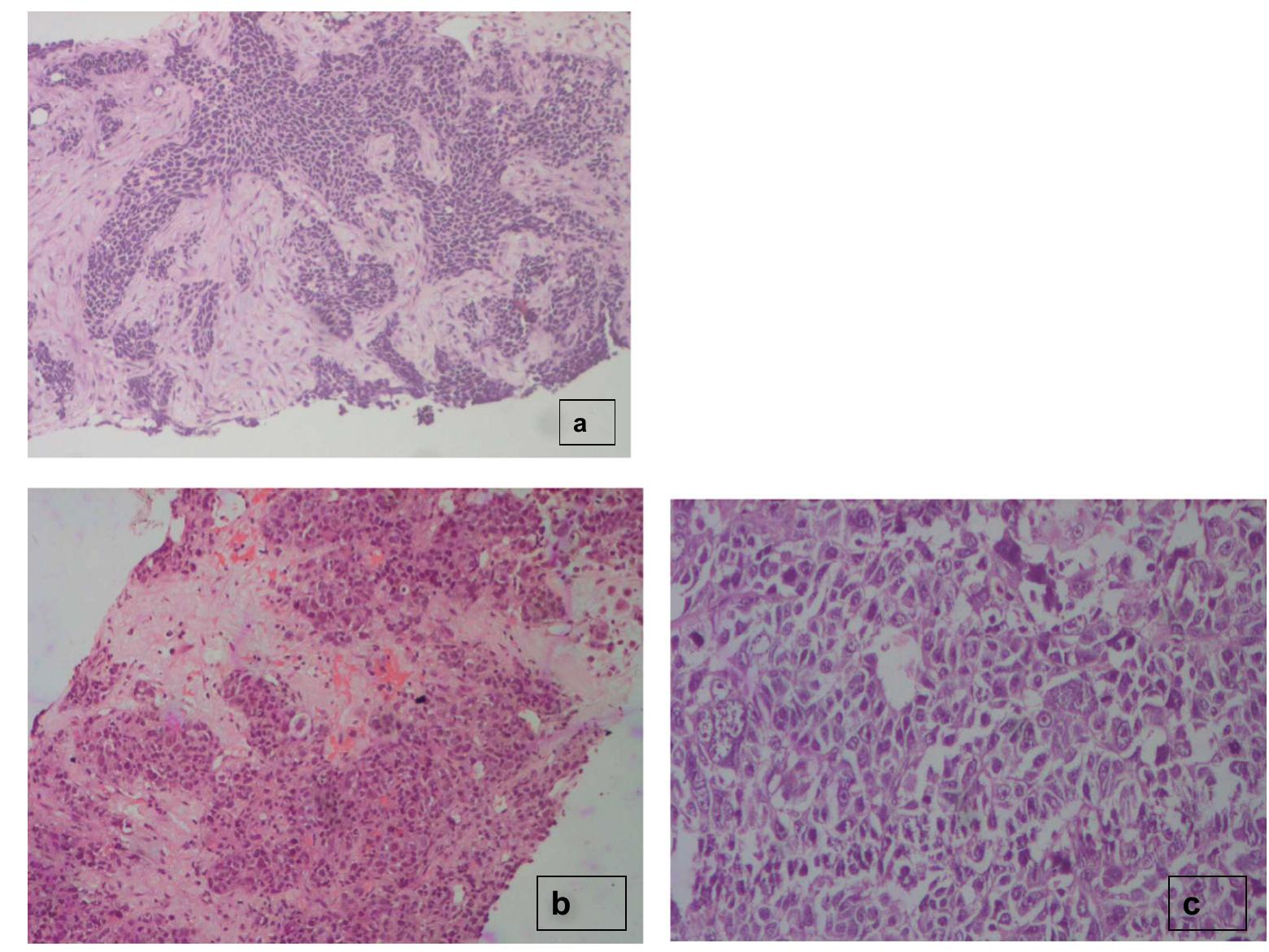 Proxamately (PDF) Neuroendocrine Carcinoma of Gall Bladder: A Series of 19 Cases ...