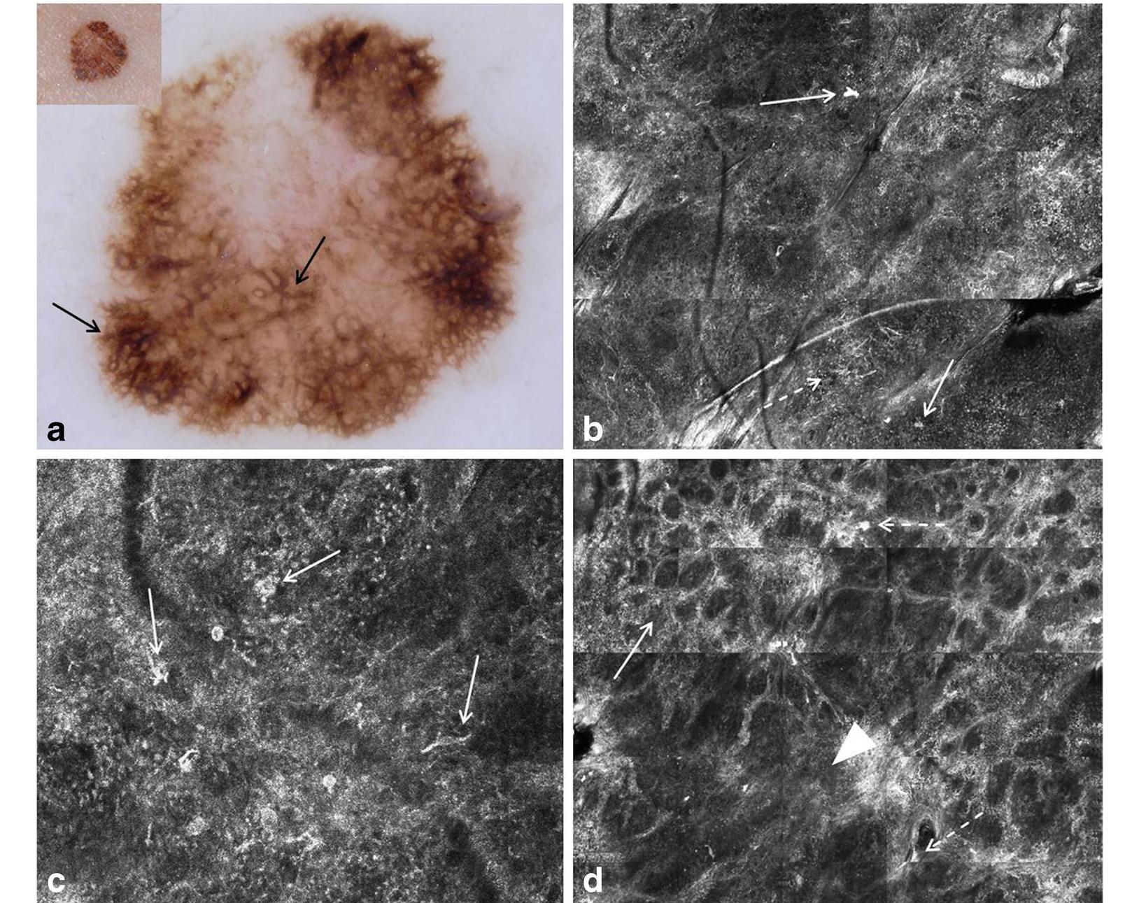 Key rcm features of melanocytic lesions *dendritic cells at