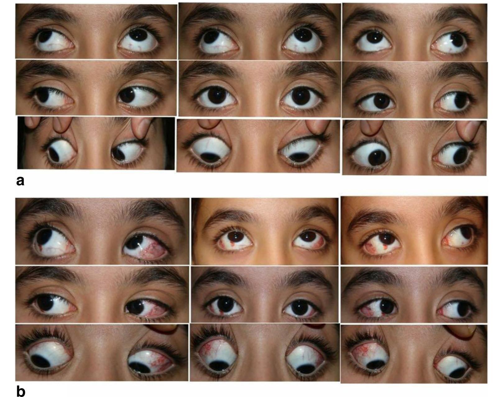 (PDF) Pseudo inferior oblique overaction, clinical findings, mechanism ...