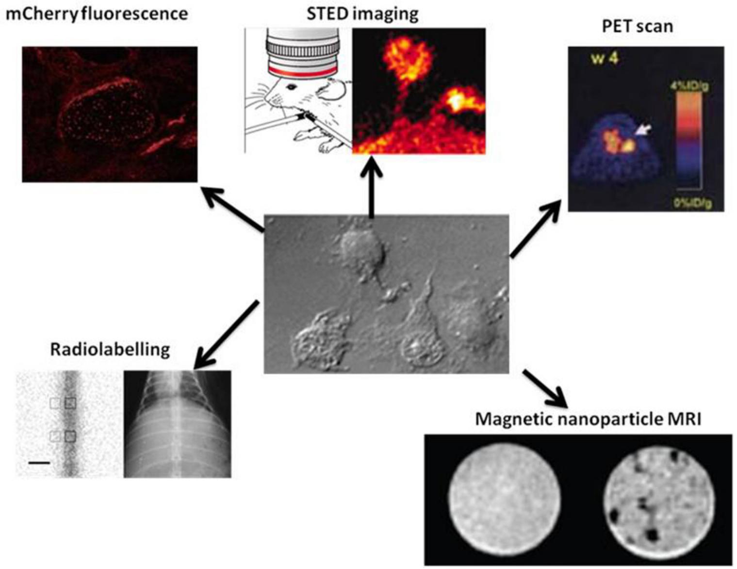 Stem Scan Injection of labelled stem cells into patient with brain