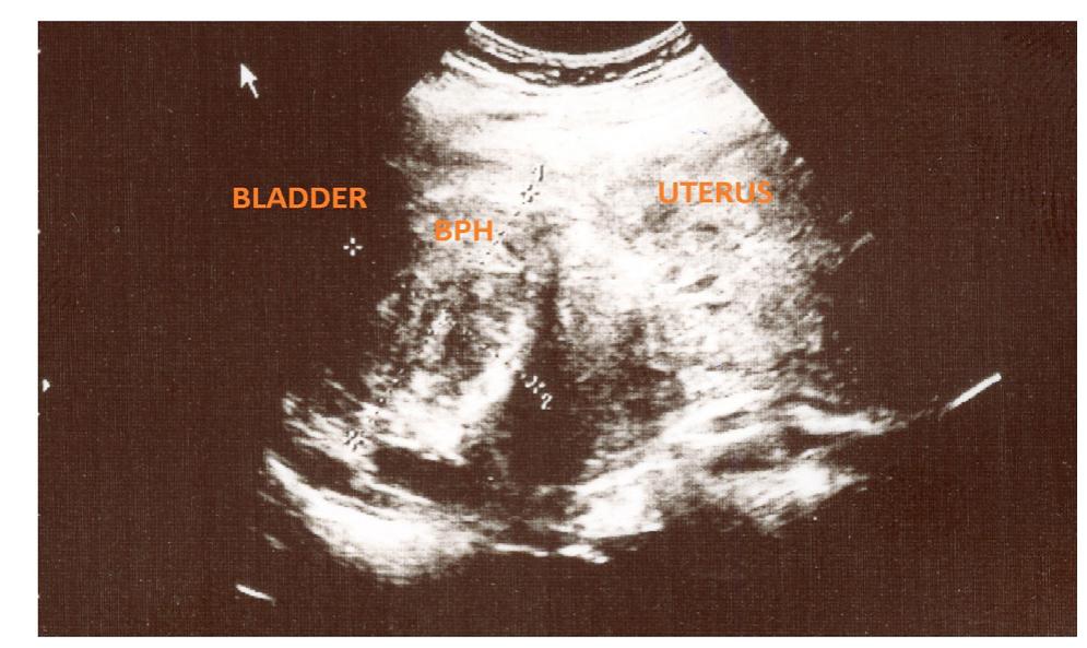 (PDF) A Case of Bladder Flap Hematoma Presenting With Hematuria