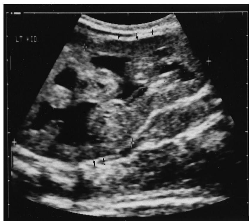 Longitudinal ultrasound reveals enlarged (9 cm) kidney with