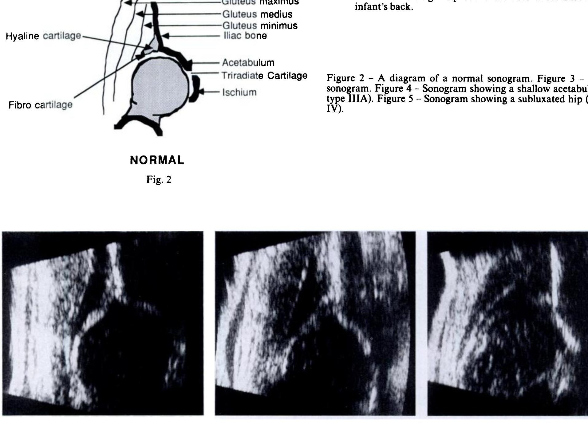 Graf’s classification (1986) of hip dysplasia 1s based on