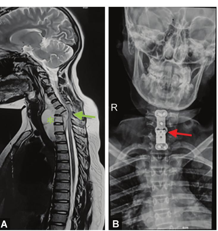 (PDF) Cervical Pott's Spine: A Case Series