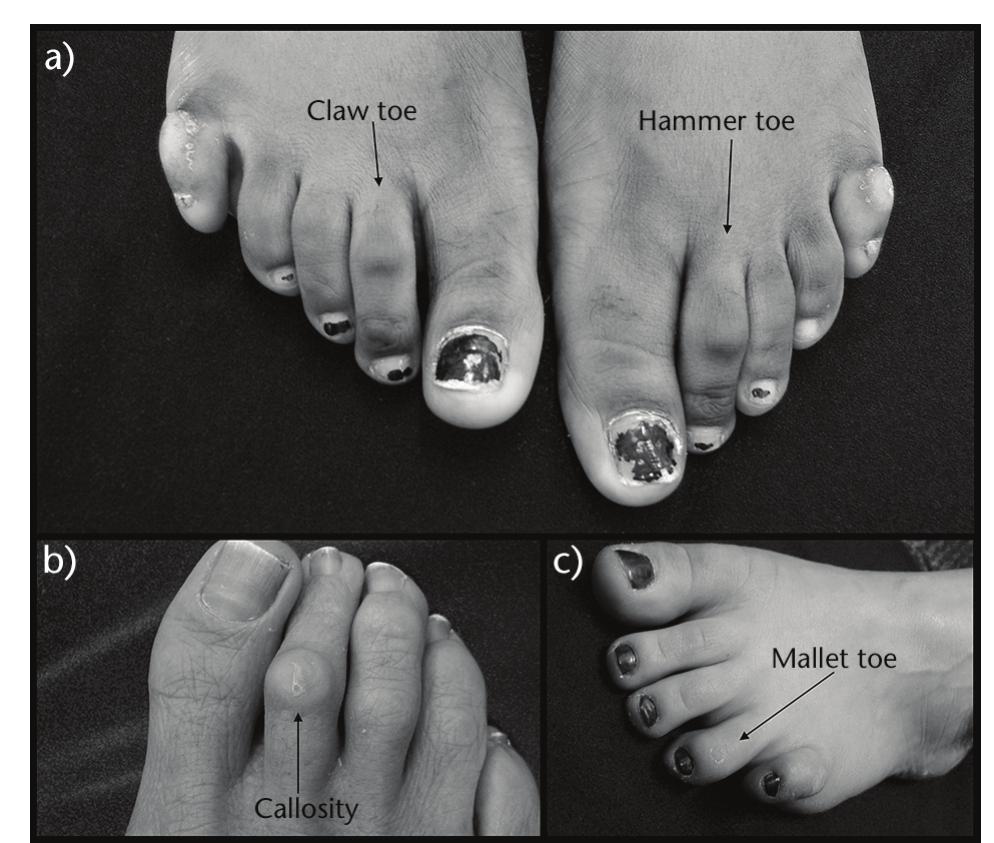 (PDF) The pathology and management of lesser toe deformities