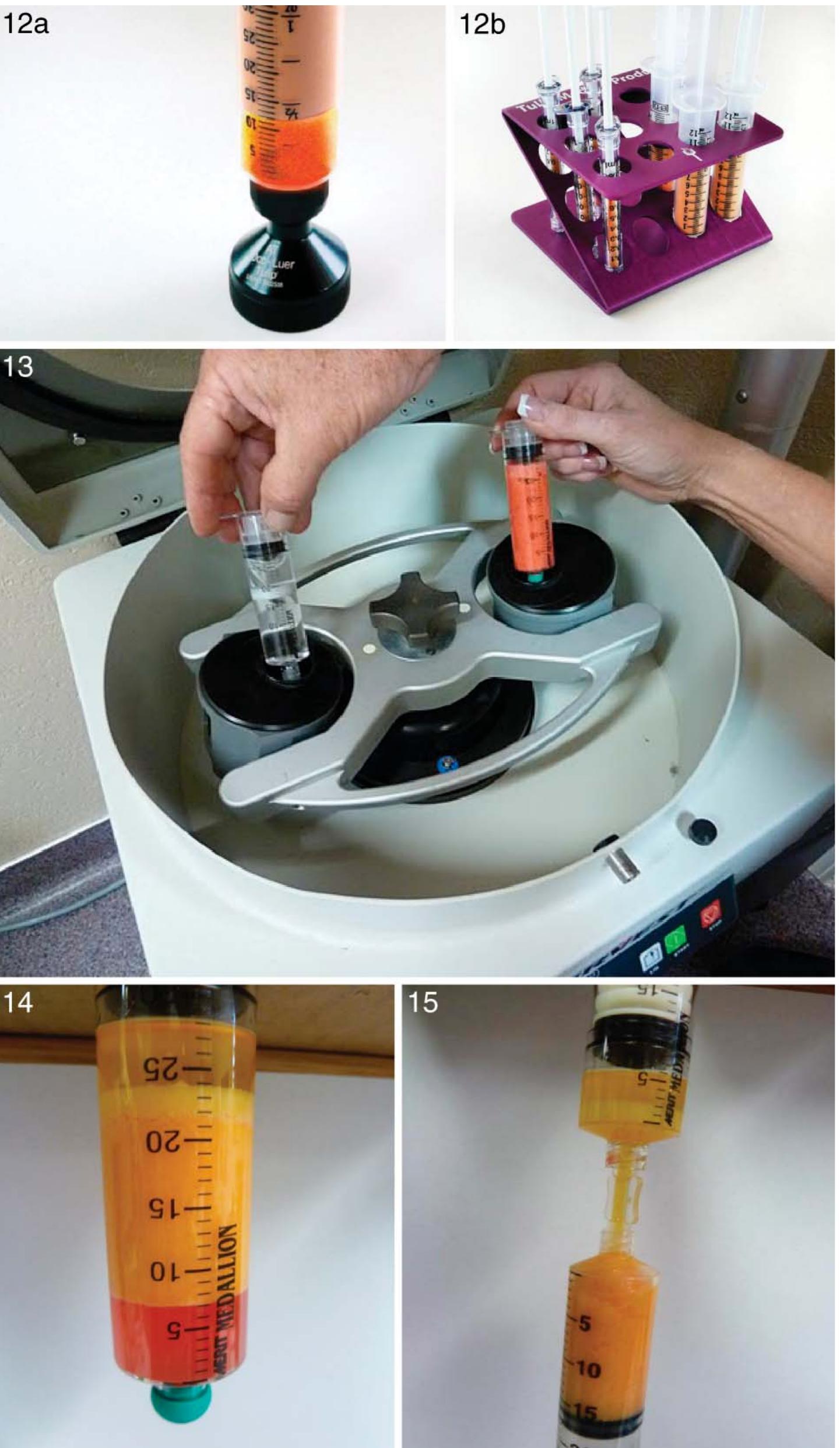 (PDF) Use of Microcannula Closed Syringe System for Safe and Effective ...