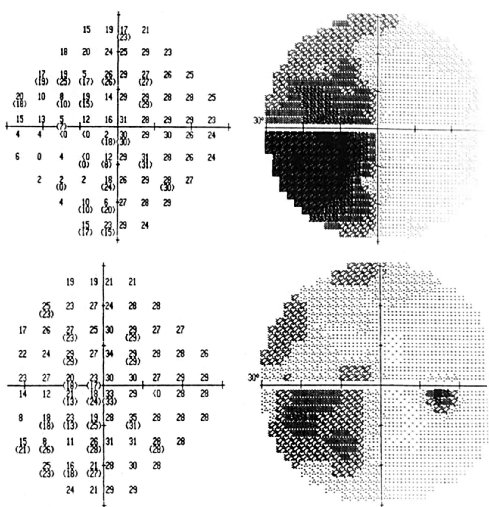 (PDF) Homonymous Field Defect as the First Manifestation of Creutzfeldt ...