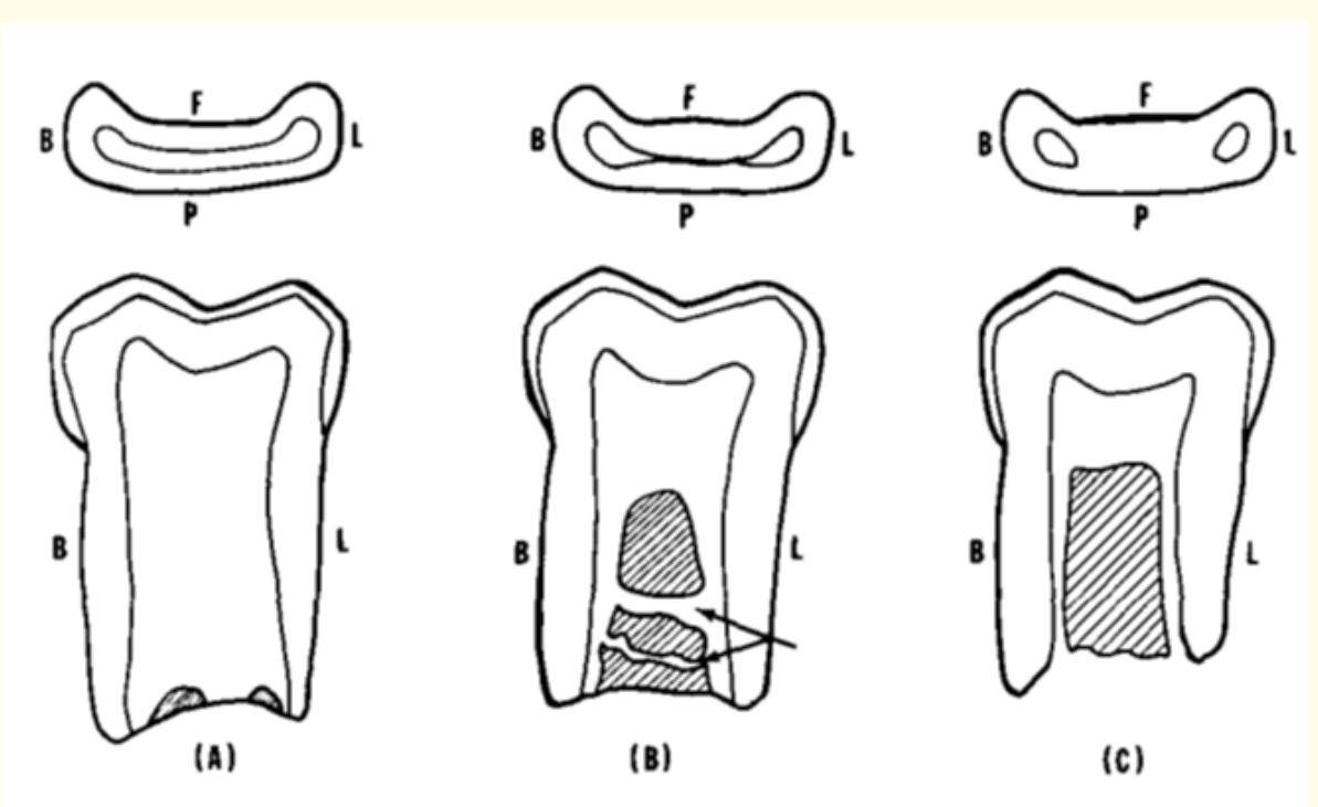 (PDF) Root Canal Treatment in Primary Teeth