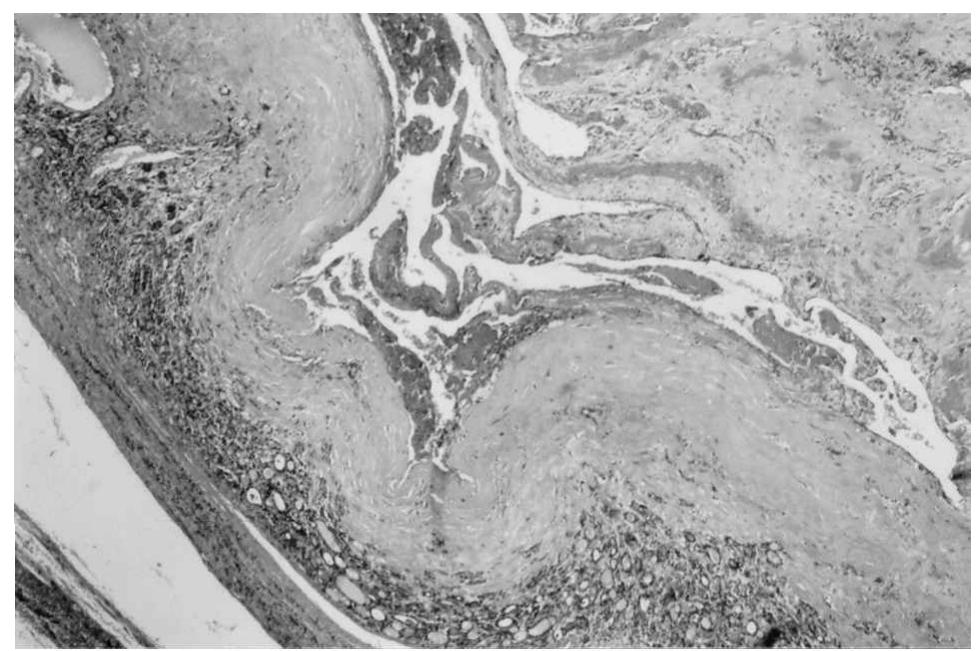 Figure 2 - from Cavernous Hemangioma of the Thyroid