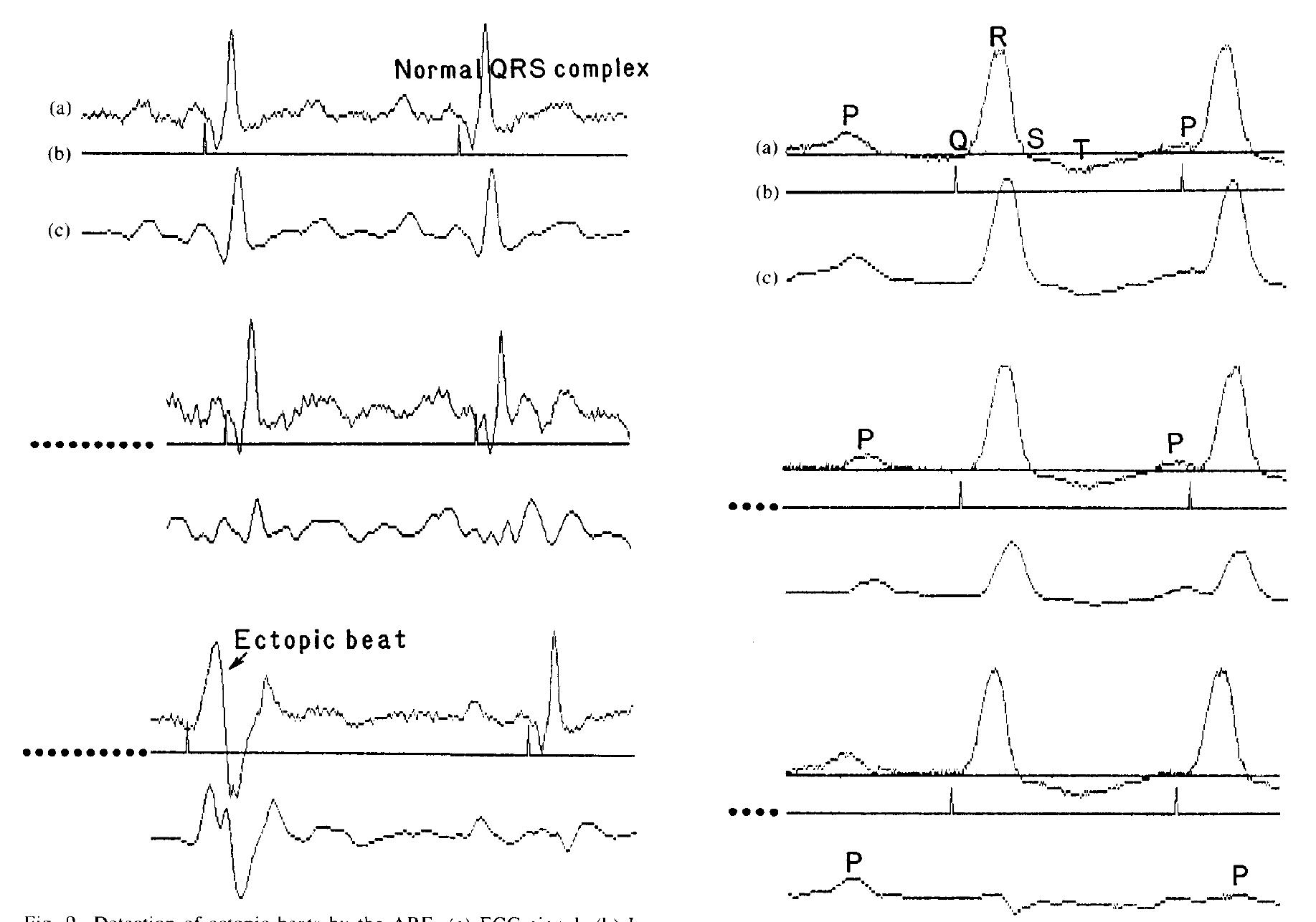 (PDF) Applications of adaptive filtering to ECG analysis: noise ...