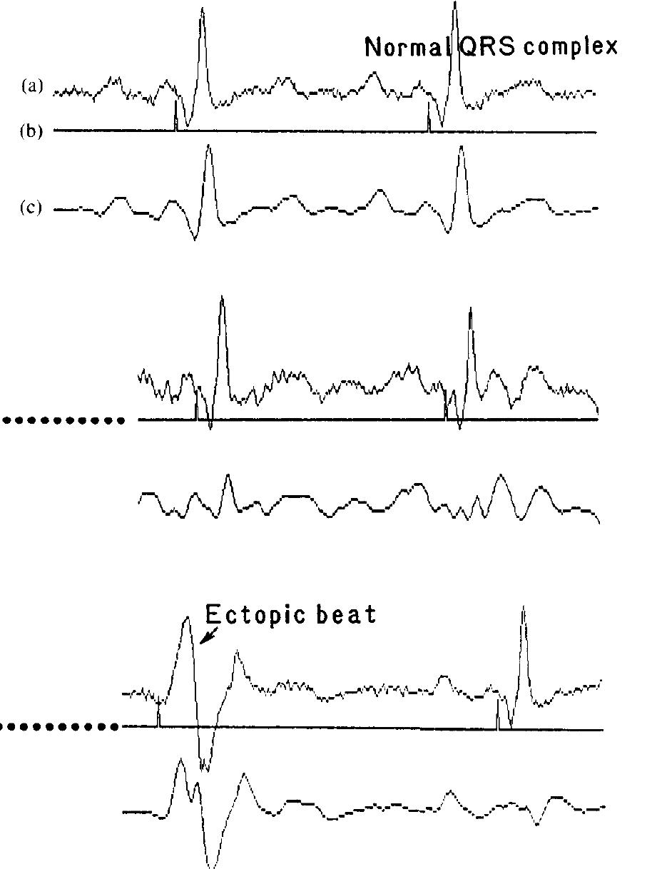 (PDF) Applications of adaptive filtering to ECG analysis: noise ...