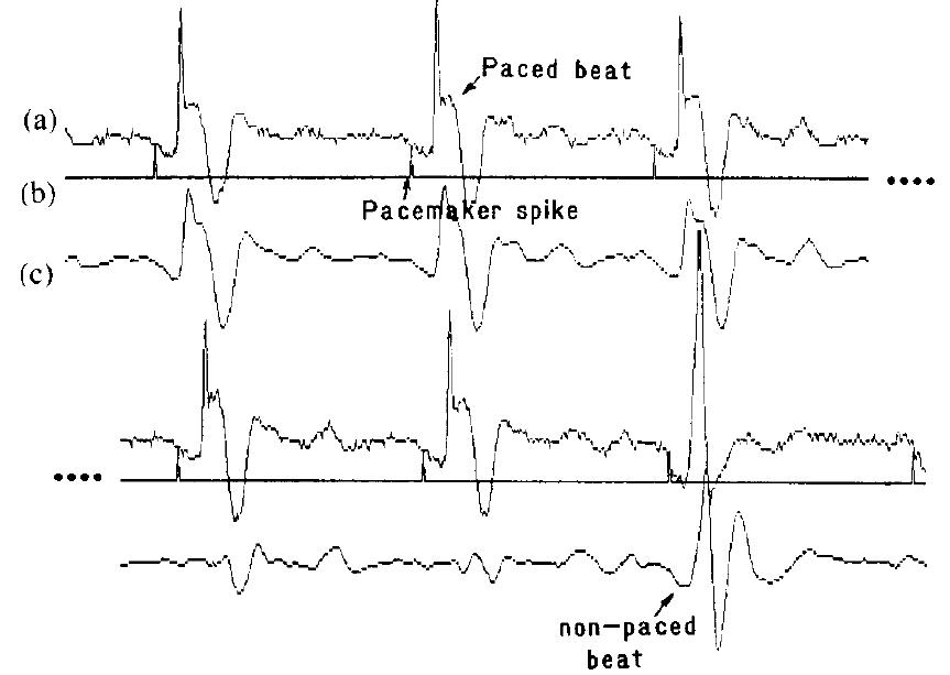 (PDF) Applications of adaptive filtering to ECG analysis: noise ...