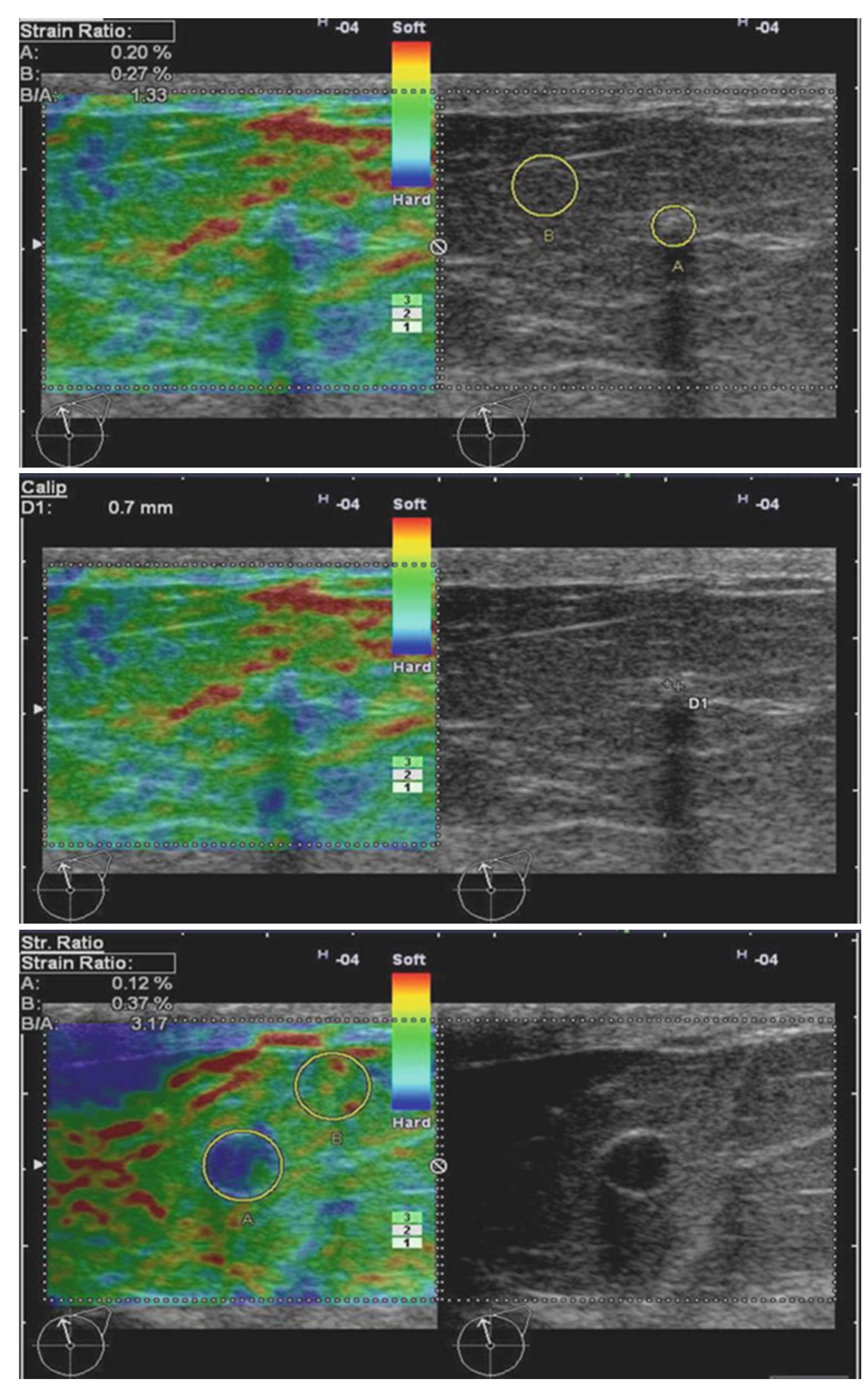 Figure 9 - Full Breast Ultrasonography of the Benign Lesions
