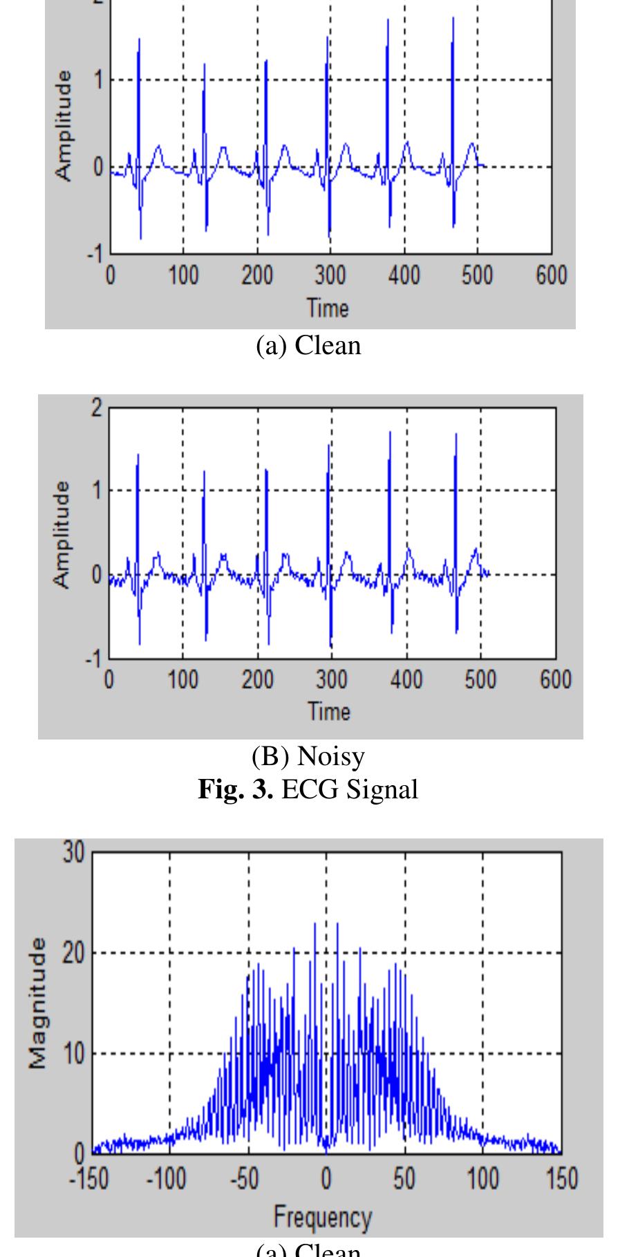 (PDF) Power Line Interference Removal from ECG Signal using Adaptive Filter