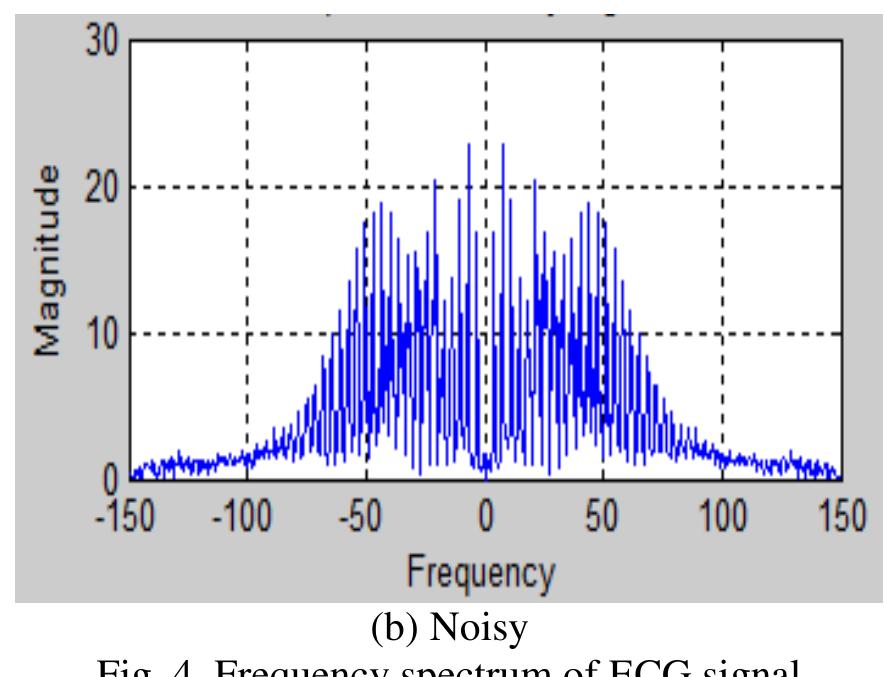 (PDF) Power Line Interference Removal from ECG Signal using Adaptive Filter