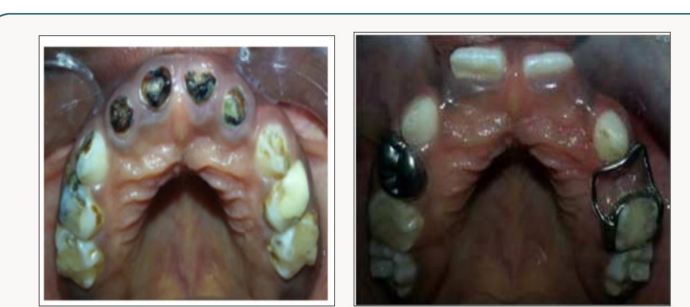 Promient Back Tooth Intraoral a. pre-of photographs of the upper occlusal view