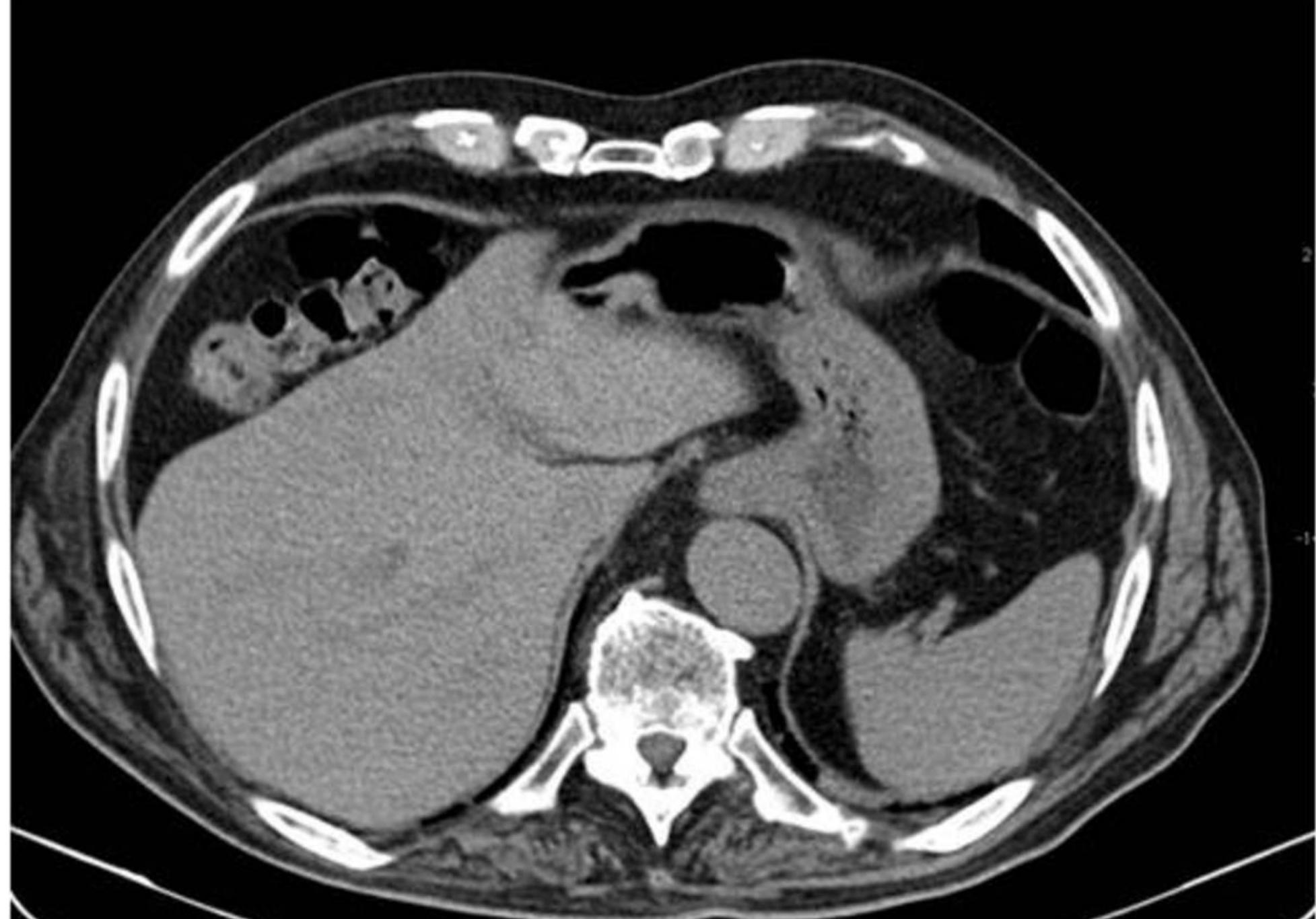 Figure 11 - Eponyms in radiologic signs
