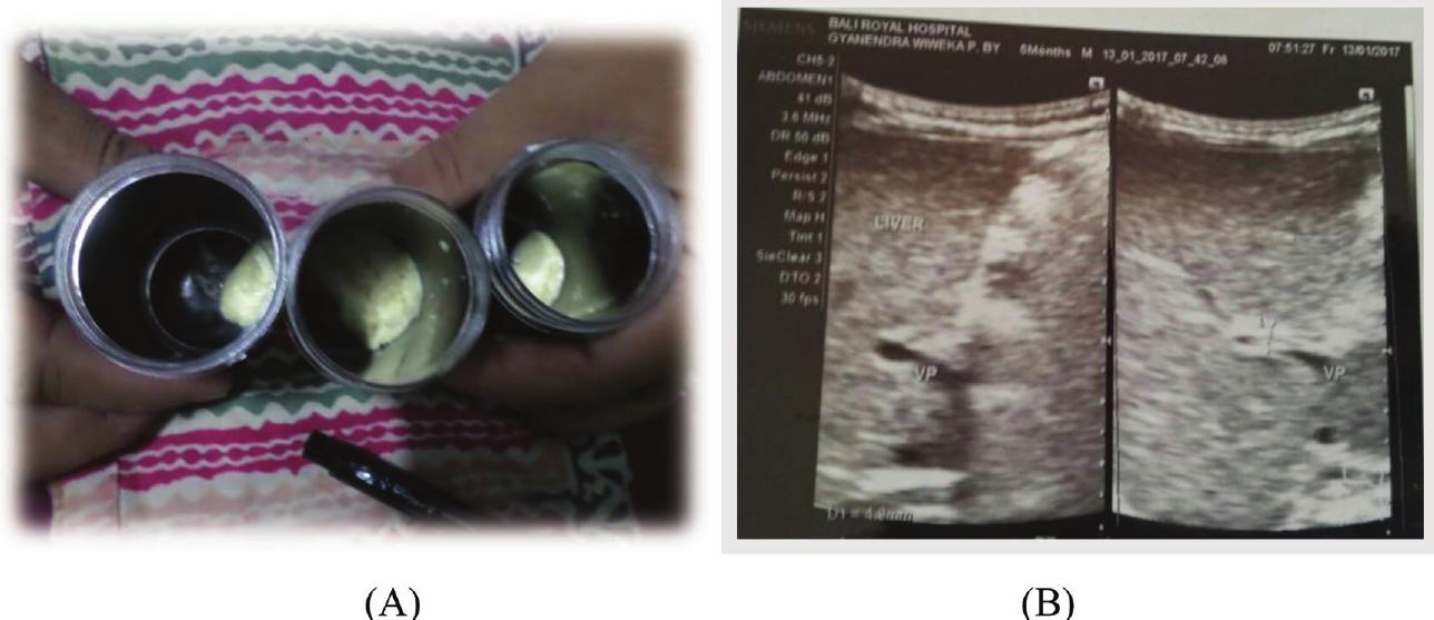 E1 diagnosing the ba. (a) acholic stool, (b) triangular cord