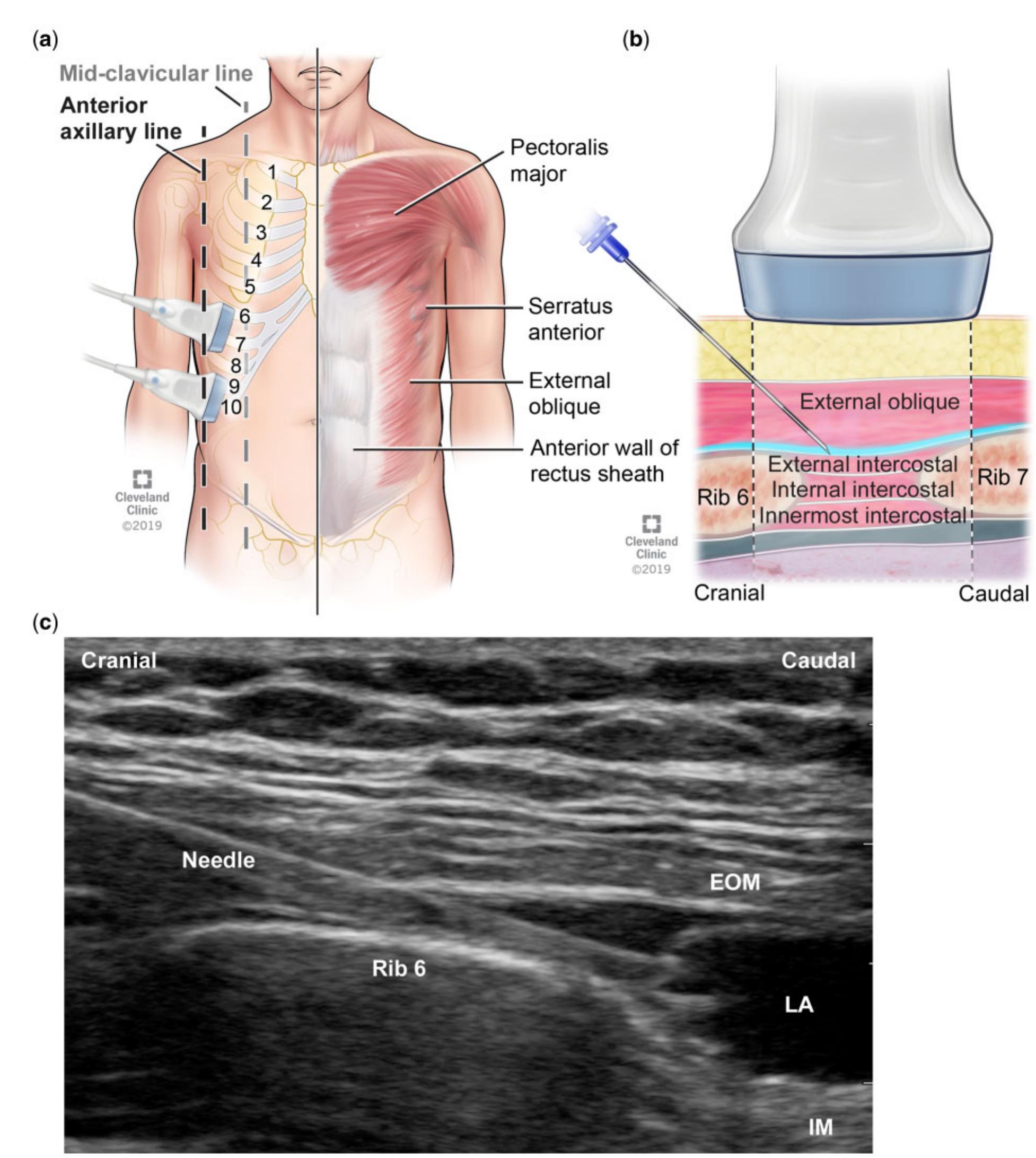 (PDF) The External Oblique Intercostal Block: Anatomic Evaluation and ...