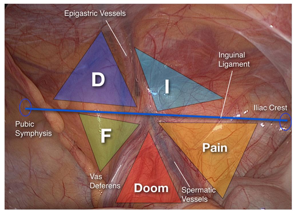 PDF Systemization Of Laparoscopic Inguinal Hernia Repair Tapp Based pdf-systemization-of-laparoscopic-inguinal-hernia-repair-tapp-based